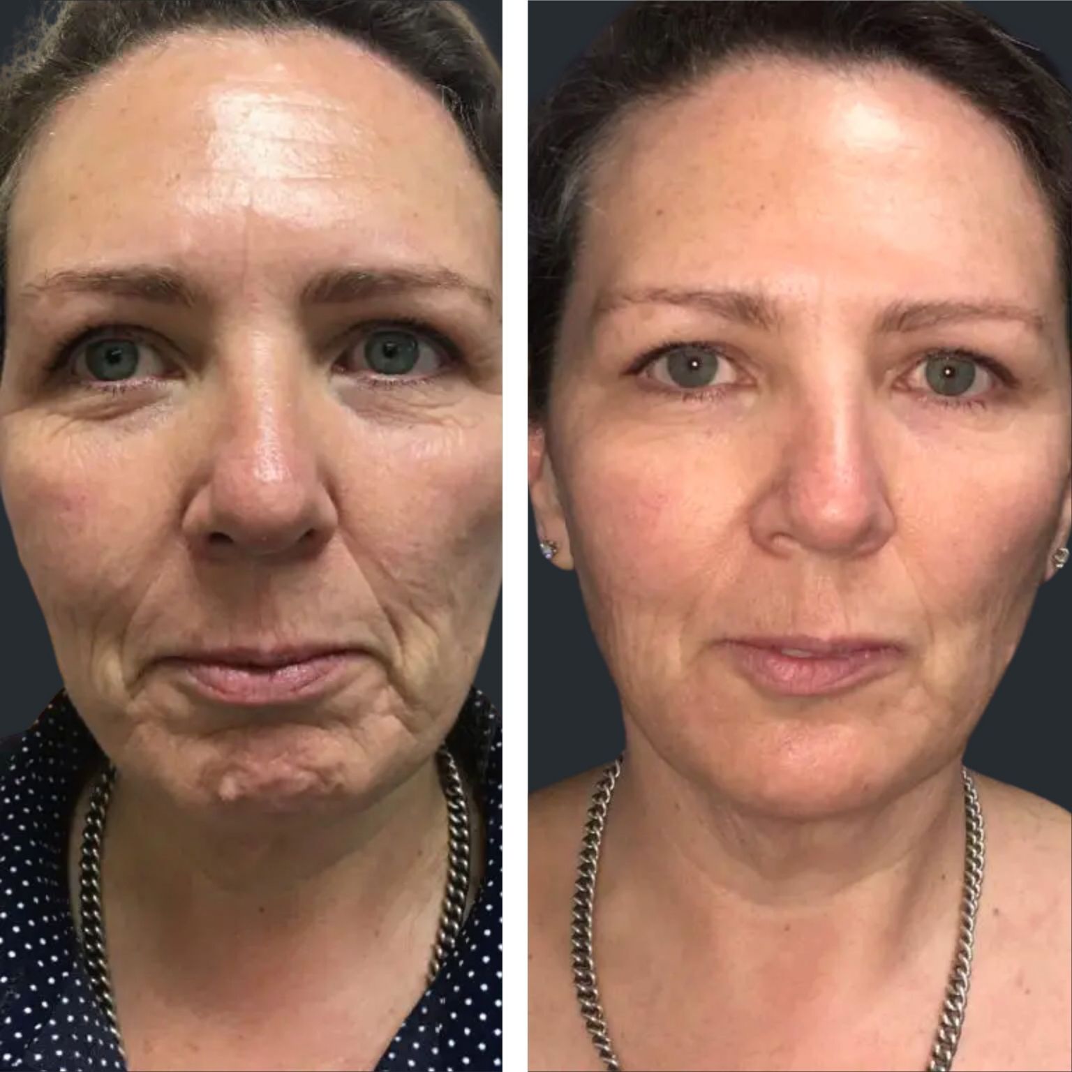 Line Treatment Brisbane Lines Filler, PDO Threads