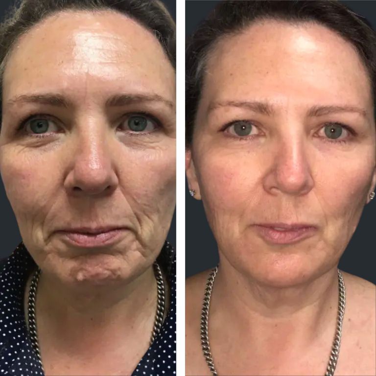 Smile Lines Filler, PDO Threads & Biostimulator Injection to Fill Smile Lines