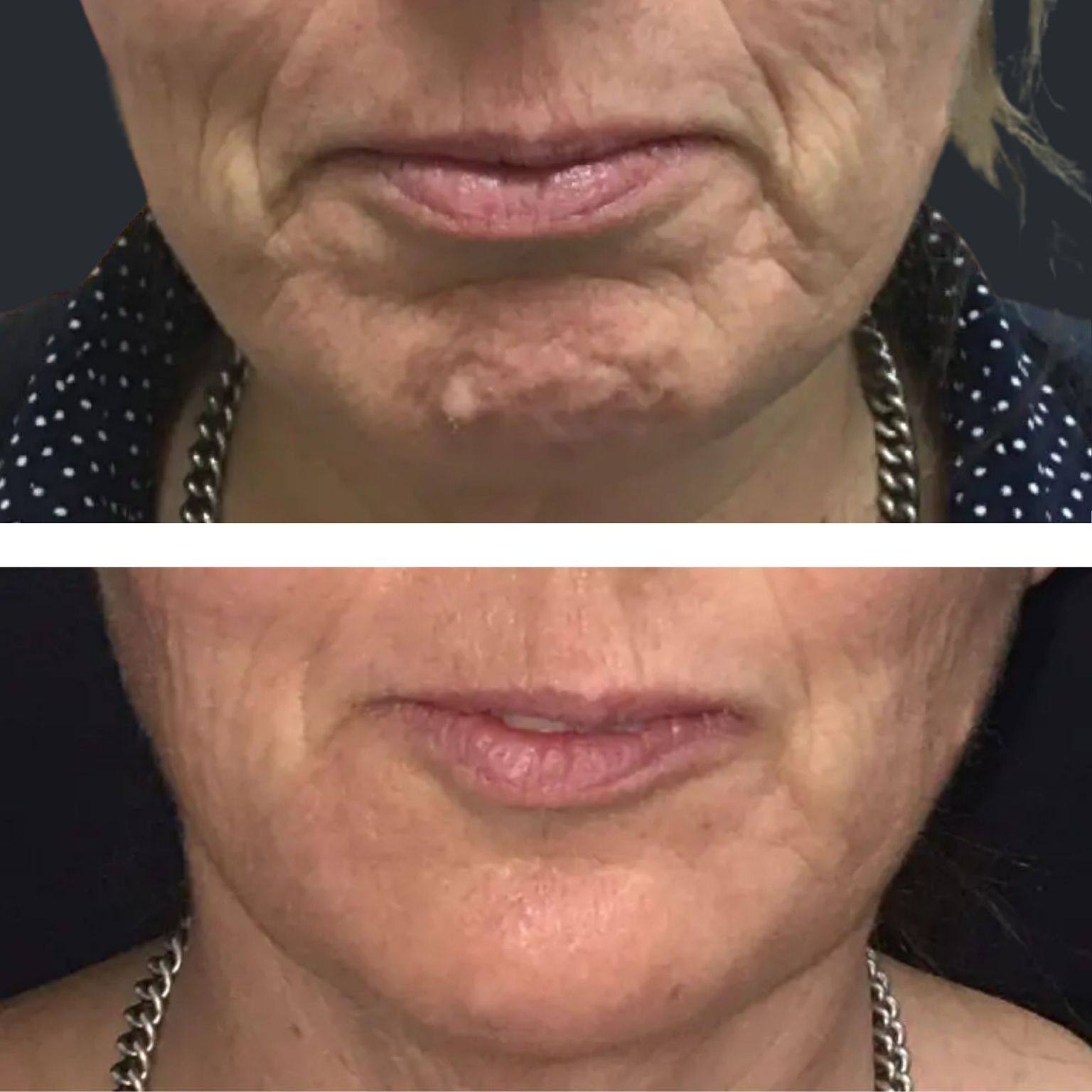 Line Treatment Brisbane Lines Filler, PDO Threads