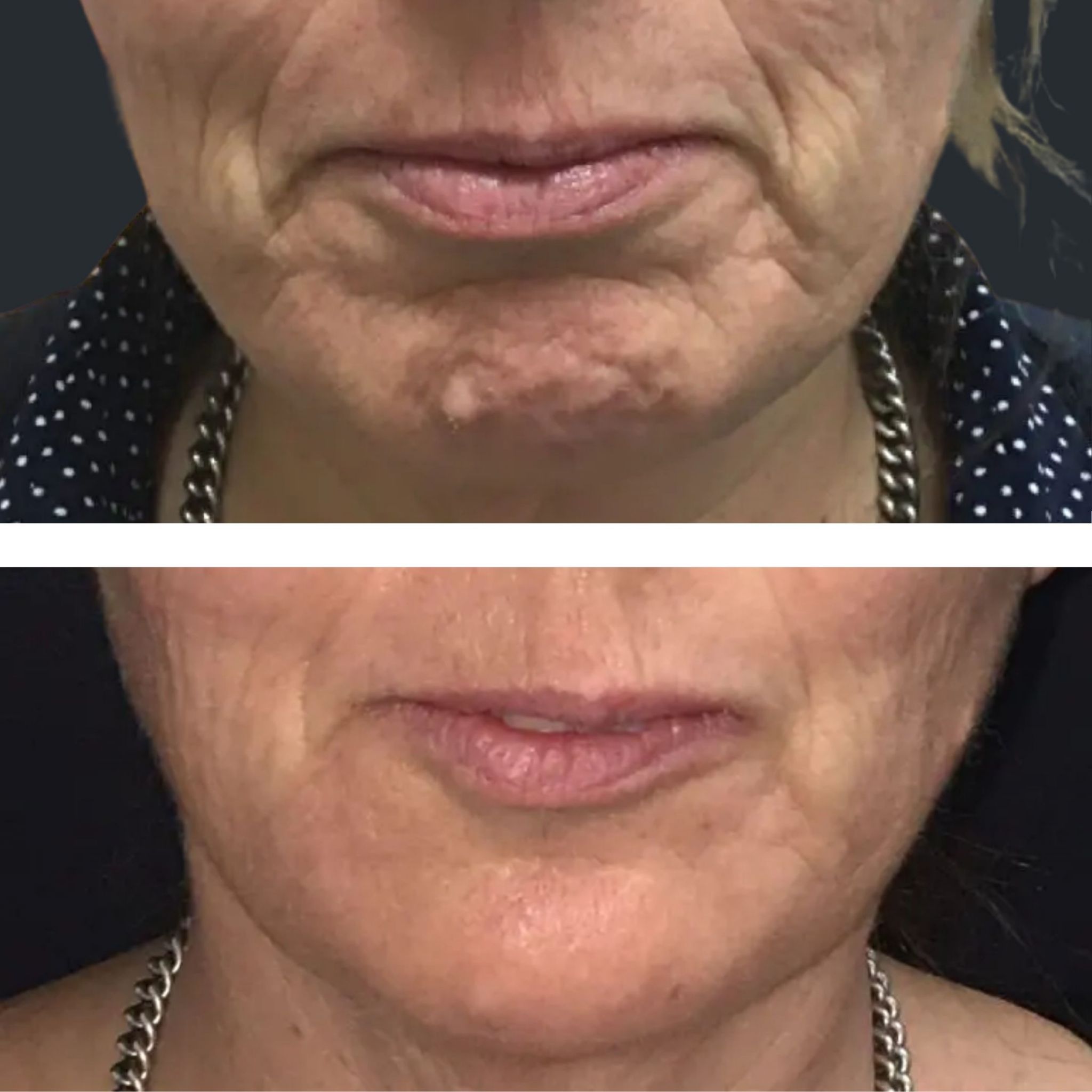 Line Treatment Brisbane Lines Filler, PDO Threads