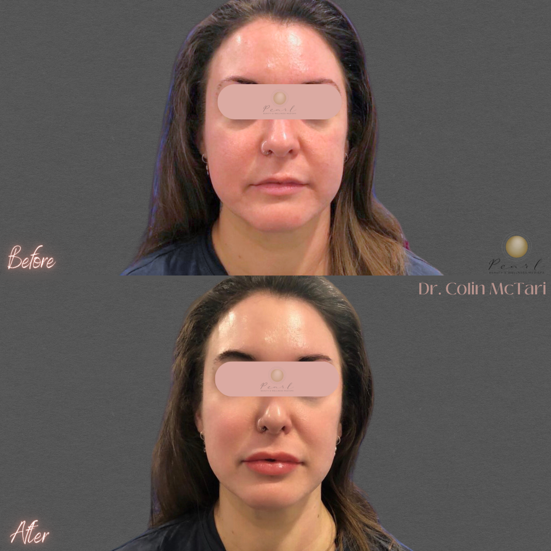 NonSurgical Face Lift Brisbane Latest Alternatives to Surgical Face