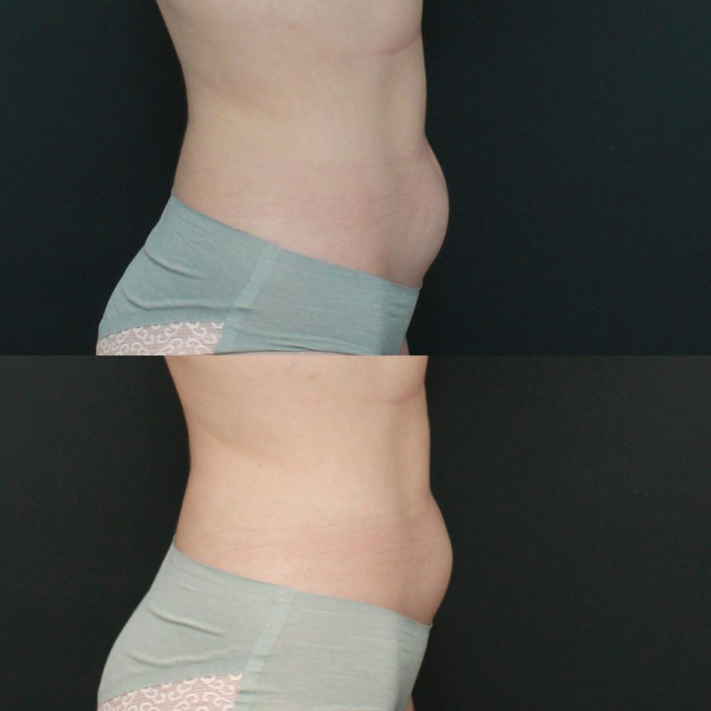 NonSurgical Liposuction Brisbane Affordable NonInvasive Fat Freezing