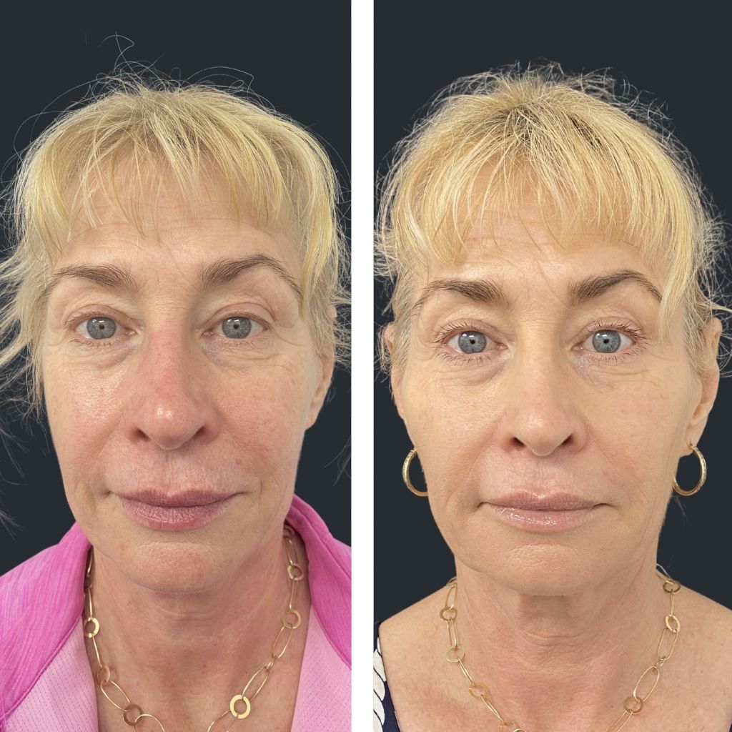 Dermal Filler Brisbane Cosmetic and Face Filler Packages