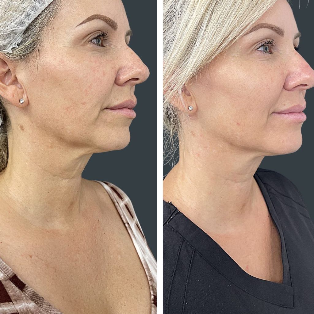 HIFU Treatment 10 50 Off HIFU for Face, Neck Tummy & Arms