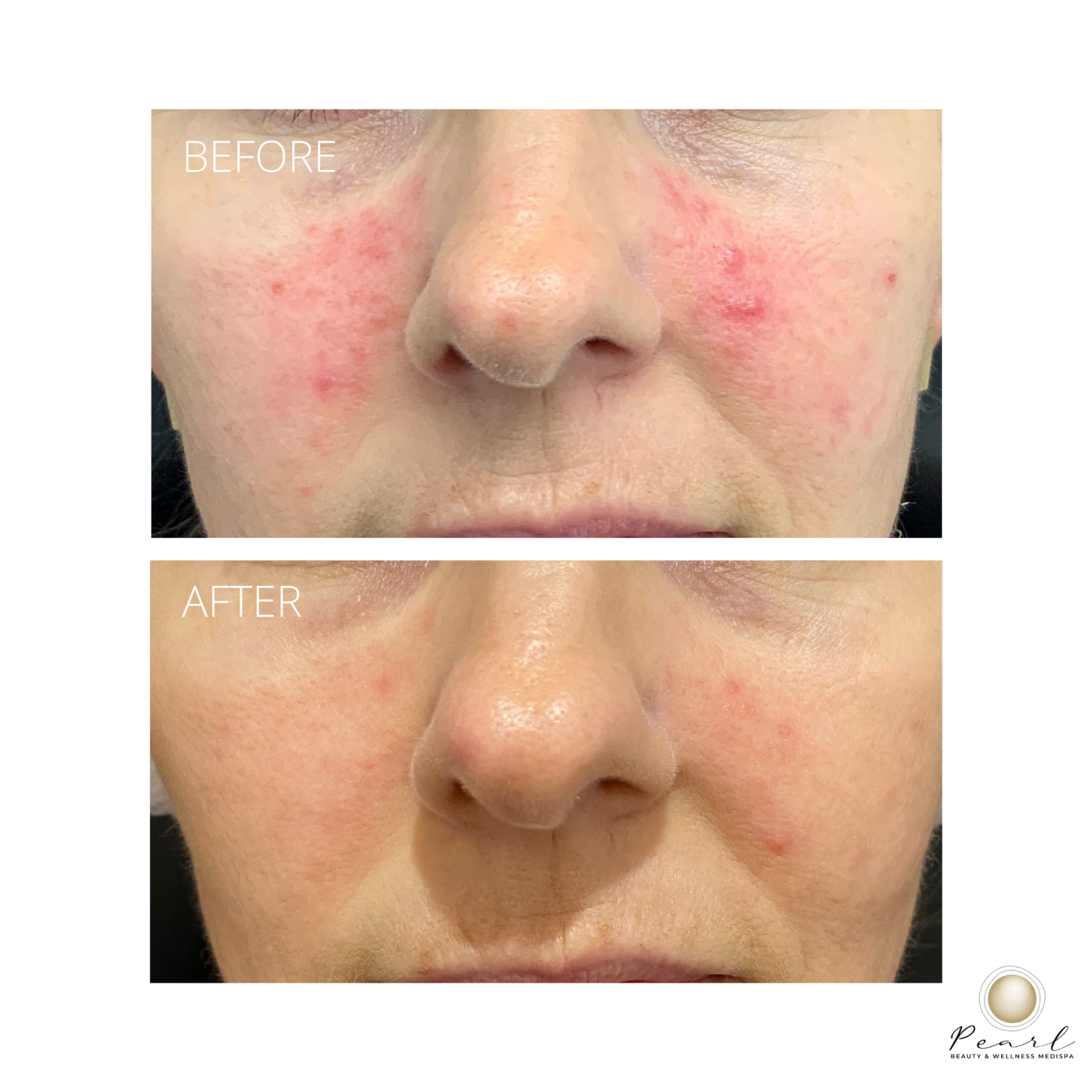 Broken Capillaries Treatment Laser, diathermy & IPL for broken capillaries