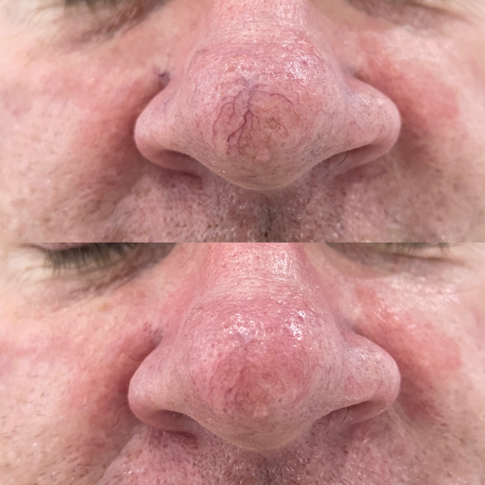 Broken Capillaries on Face IPL for Broken Capillaries on Face IPL Nose