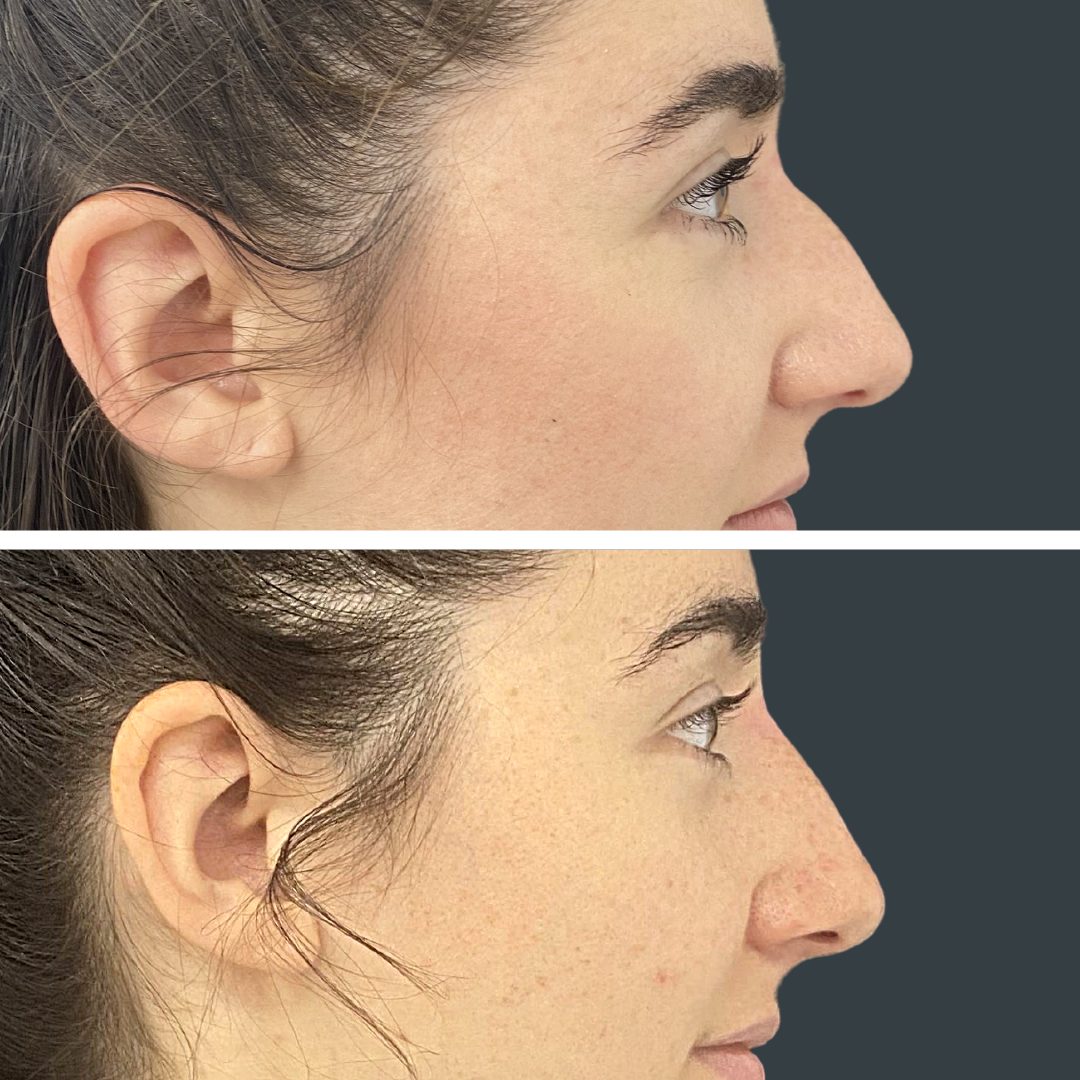 NonSurgical Rhinoplasty Nose Shaper, Nose Filler or Hiko Nose Thread