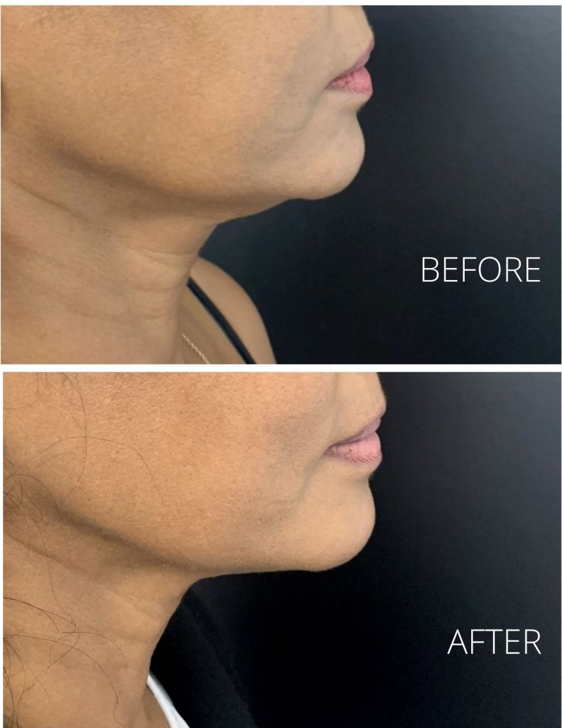 Nonsurgical Jowl Lift Thread Lift, HIFU, Injectables & Fillers for Jowl