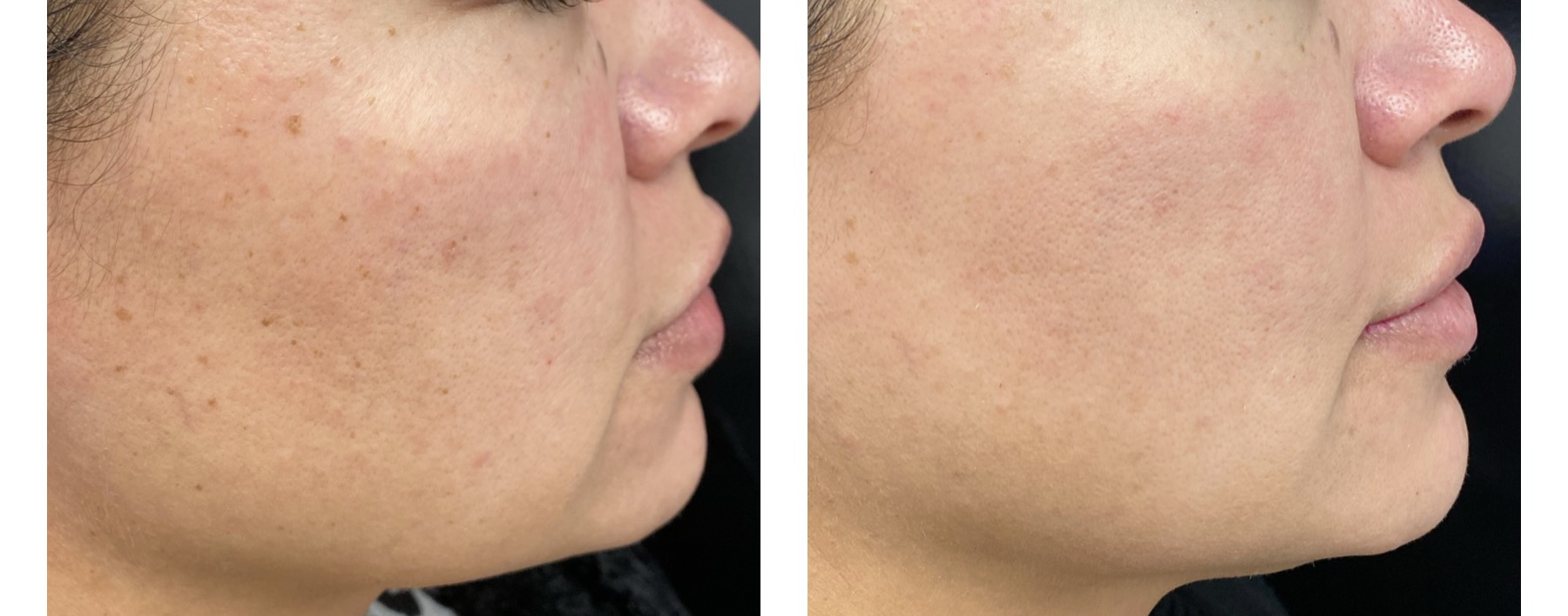 Laser Freckle Removal Get Rid Of Freckles with Laser, IPL & TCA Peels