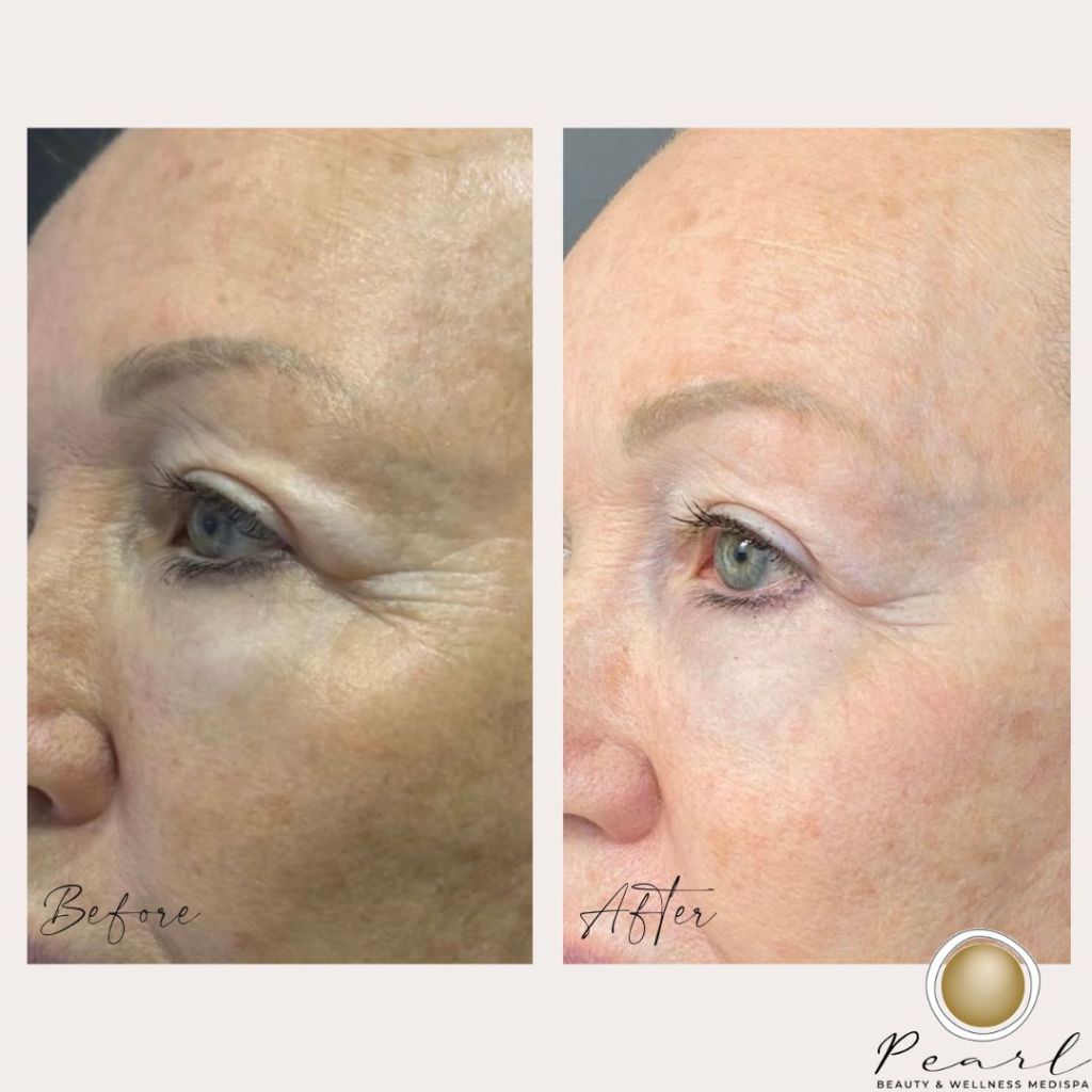 Before and After Image - 3 Tixel Eye Treatments
