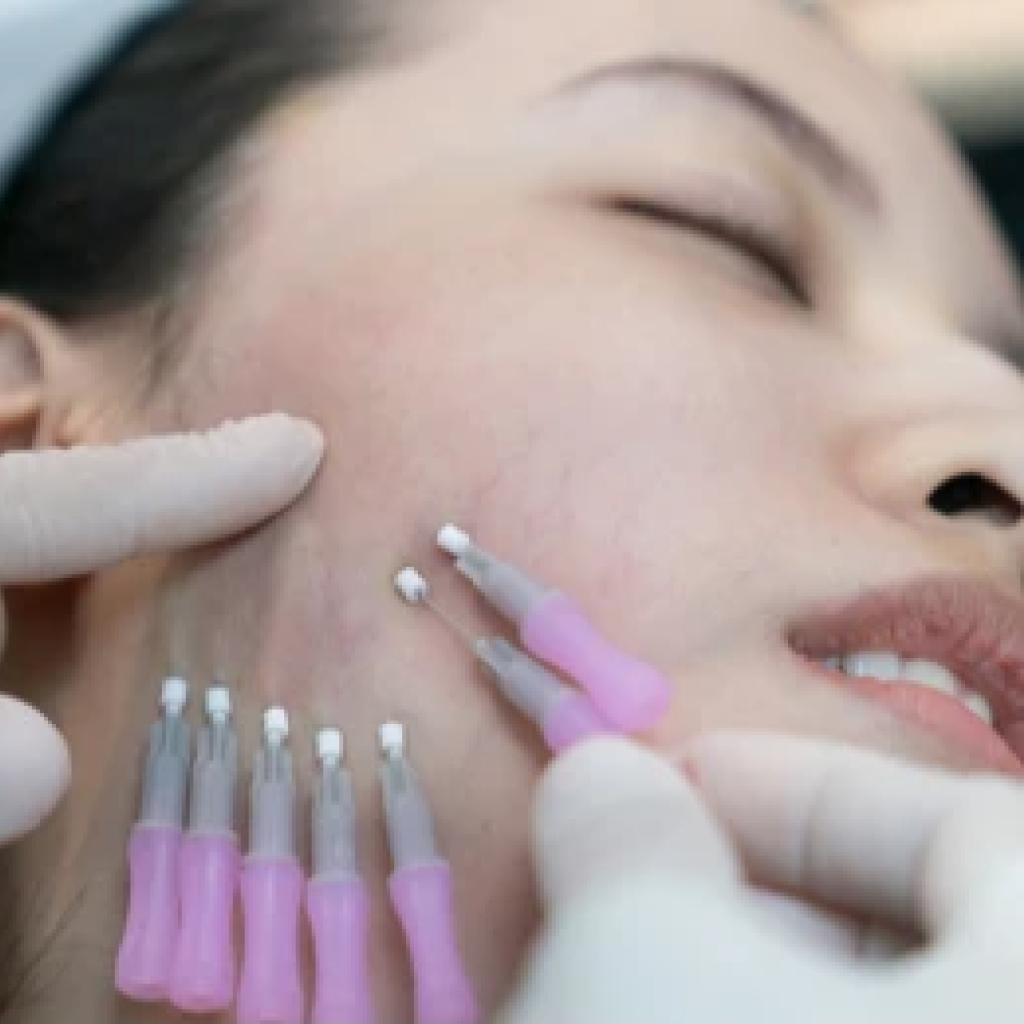 Korean Thread Facelift Brisbane, PDO Thread Lift or V Lift Facelift