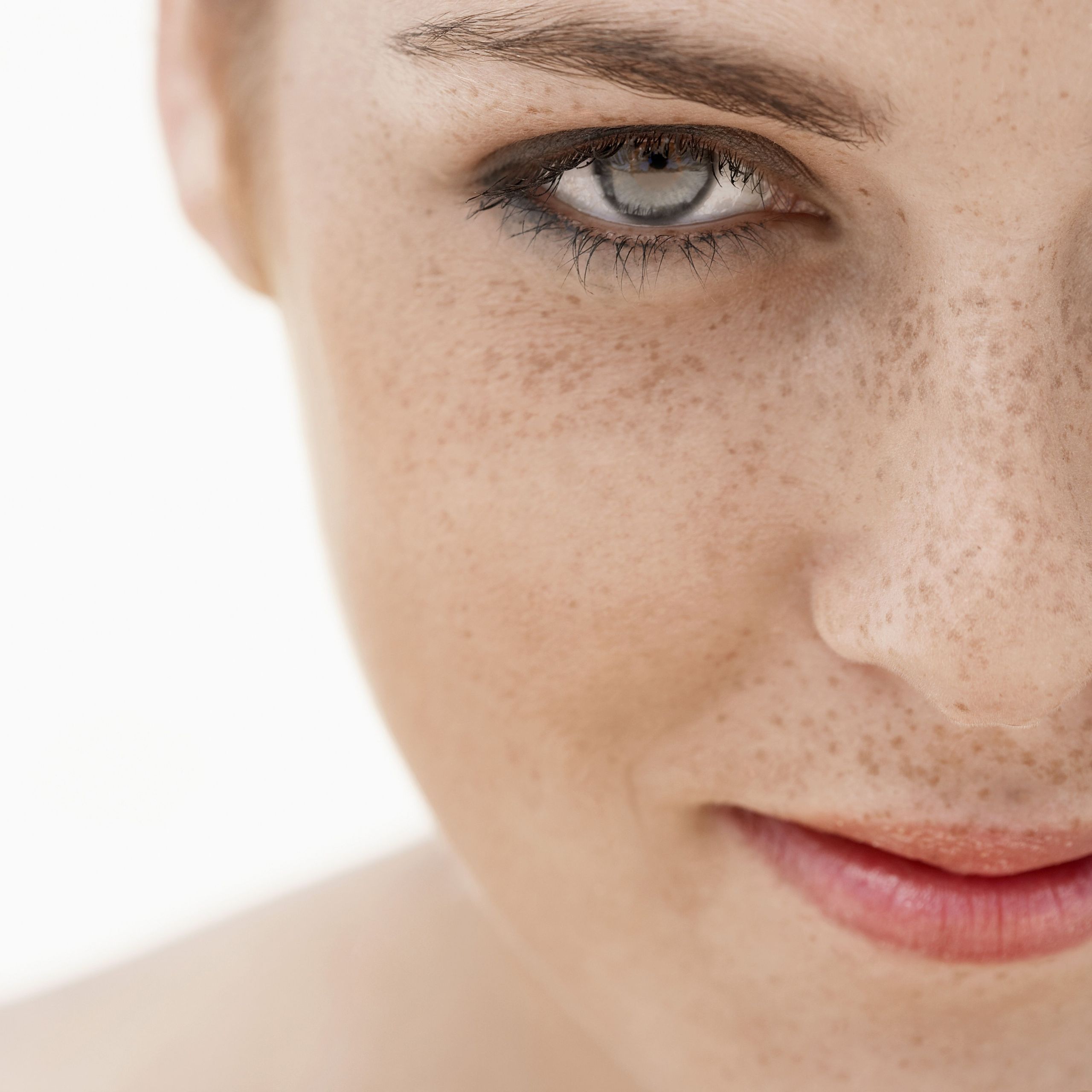 Laser Freckle Removal Get Rid Of Freckles with Laser, IPL & TCA Peels