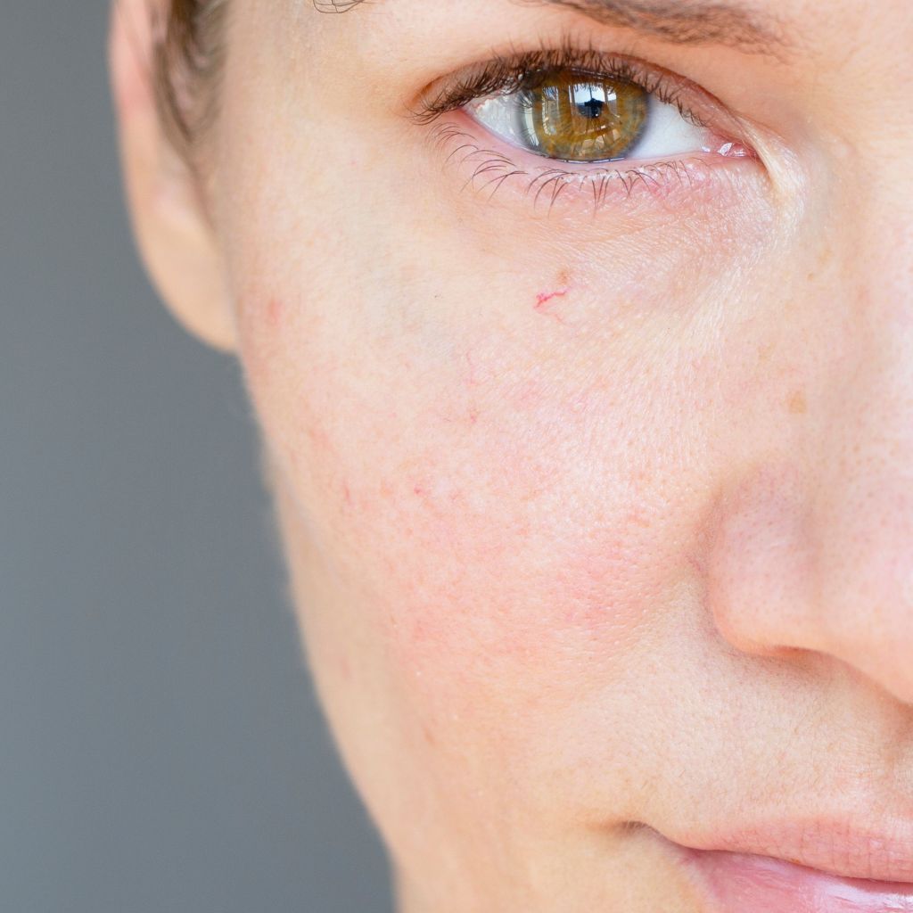 Vascular Laser Brisbane Is IPL better than laser for redness