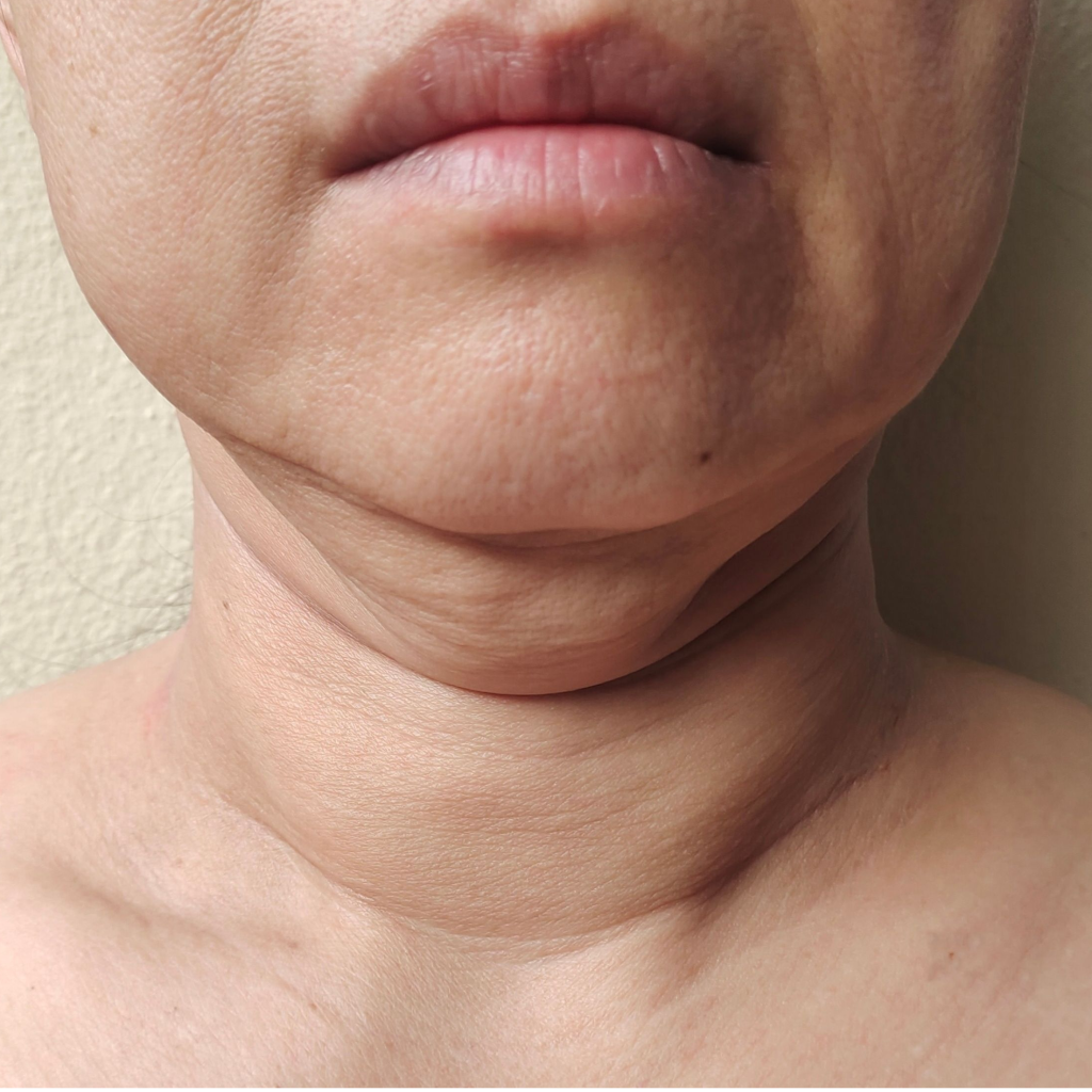 Discover Effective Turkey Neck Treatment Options in Brisbane