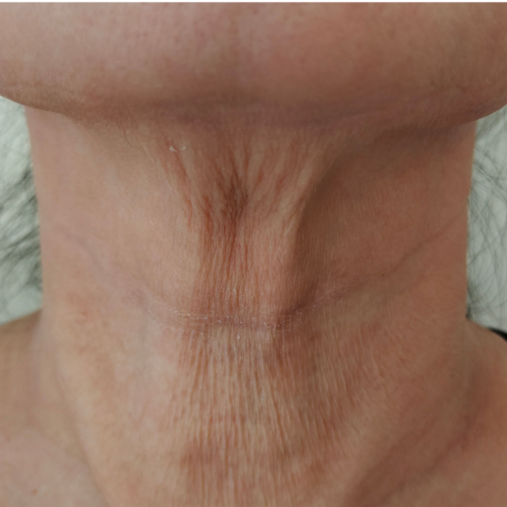 Discover Effective Turkey Neck Treatment Options in Brisbane