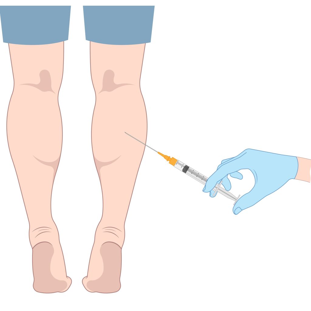 Calf Slimming Injections Leaner, Sculpted Legs Leg Slimming