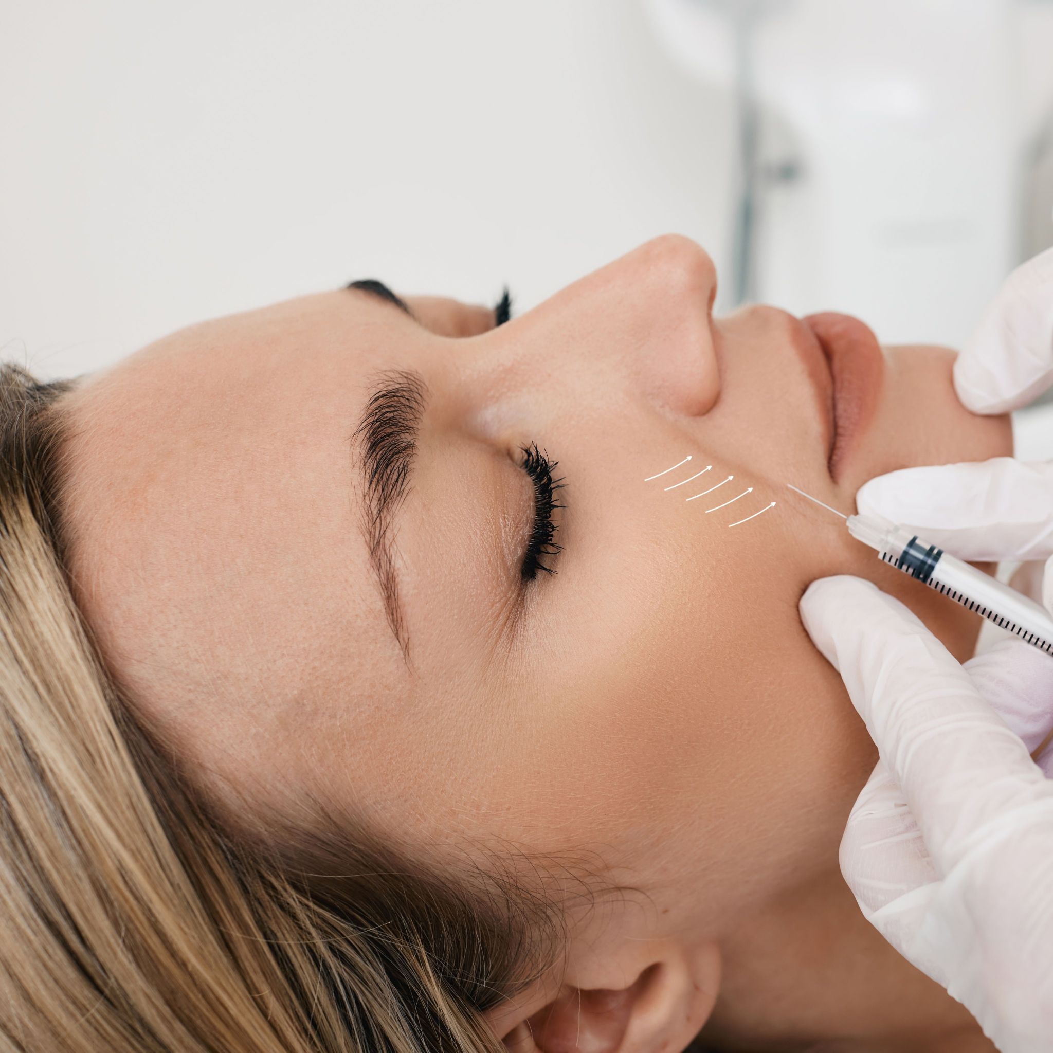 Nasolabial Fold Filler Brisbane PDO Threads, Cheek & Nasal Fold Filler