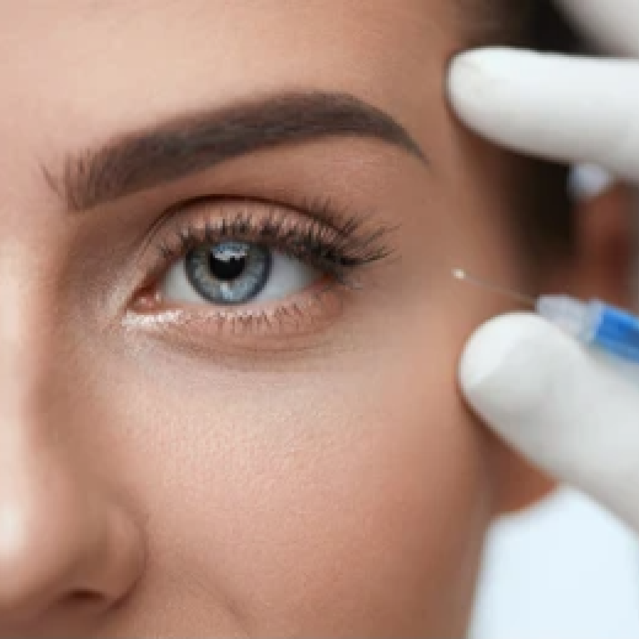 Laser for Eye Wrinkles CO2, Pico and Tixel Laser for UnderEye Wrinkles