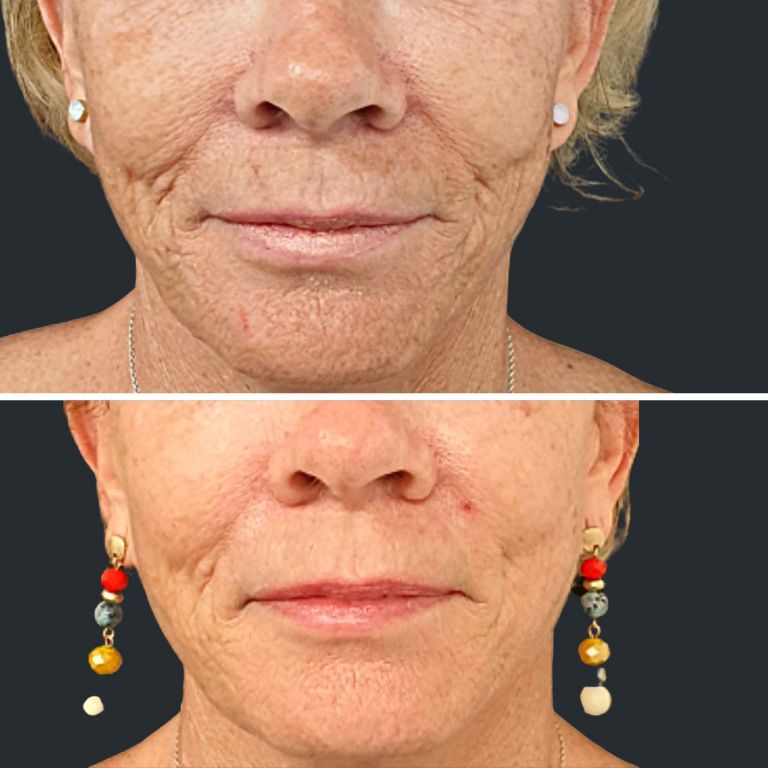 Thread Face Lift | PDO Mono Thread Lifts at Pearl Medispa Brisbane