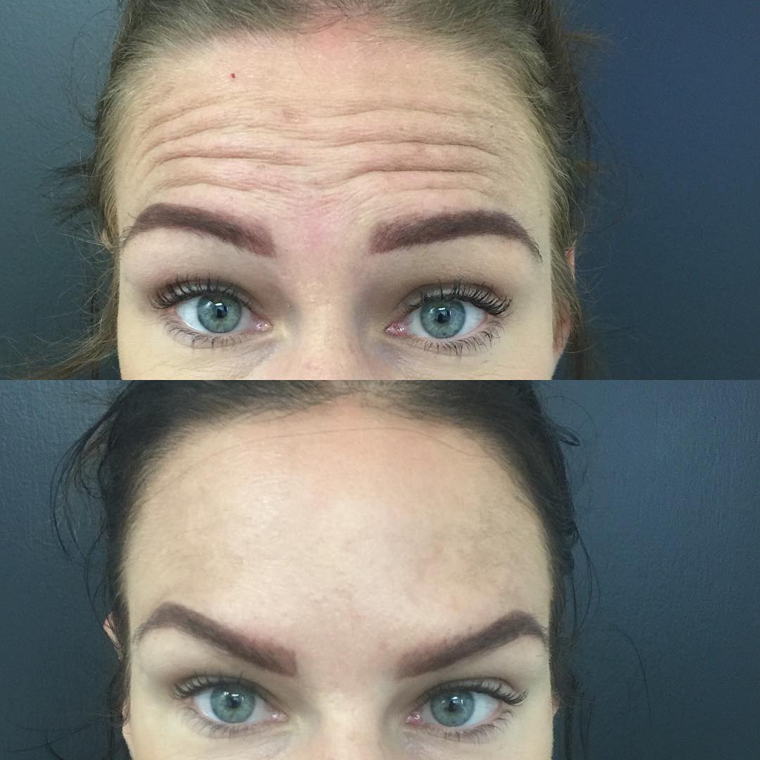 Forehead Wrinkles Treatment Injections Laser Cream For Forehead Lines