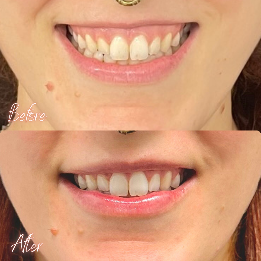 Lip Flip Brisbane Lip AntiWrinkle Injections for Fuller Lips or Lip