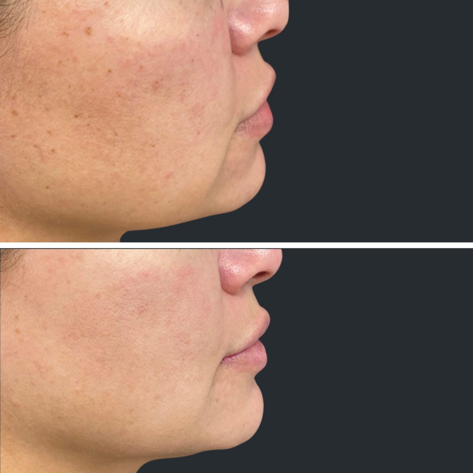 BBL Laser BBL Treatment including BBL Forever Young & BBL Facial