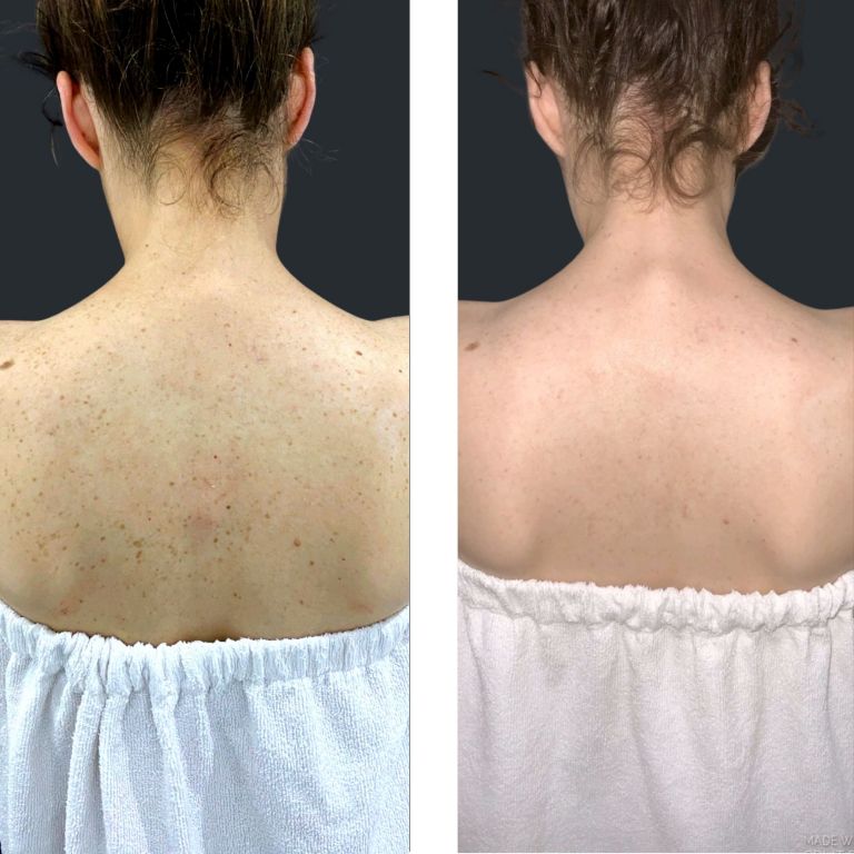 BBL Laser BBL Treatment including BBL Forever Young & BBL Facial