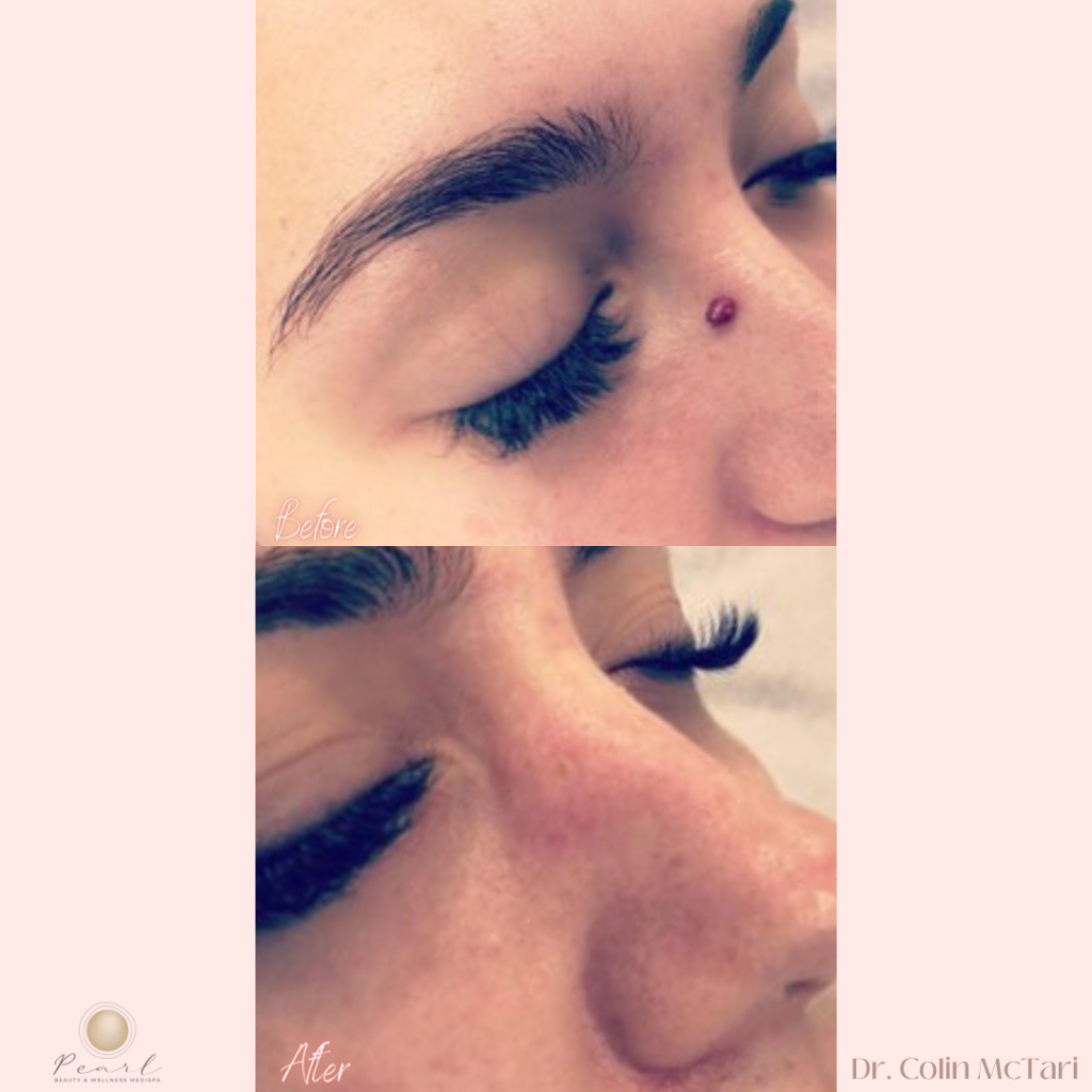 Laser Mole Removal for Facial Mole Removal or Cosmetic Mole Removal