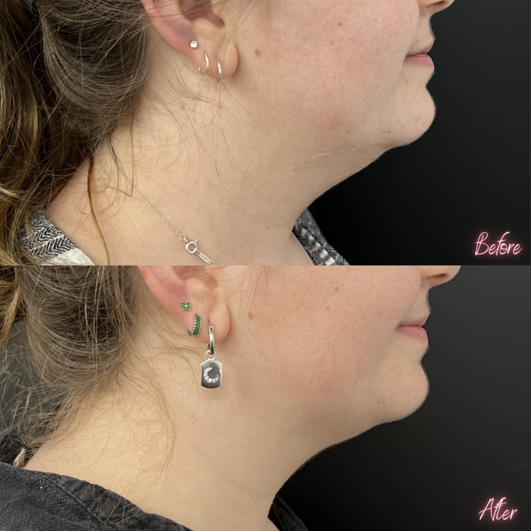 Fat Dissolving Injections Belly Chin Fat Dissolving Injectors Lipodissolve