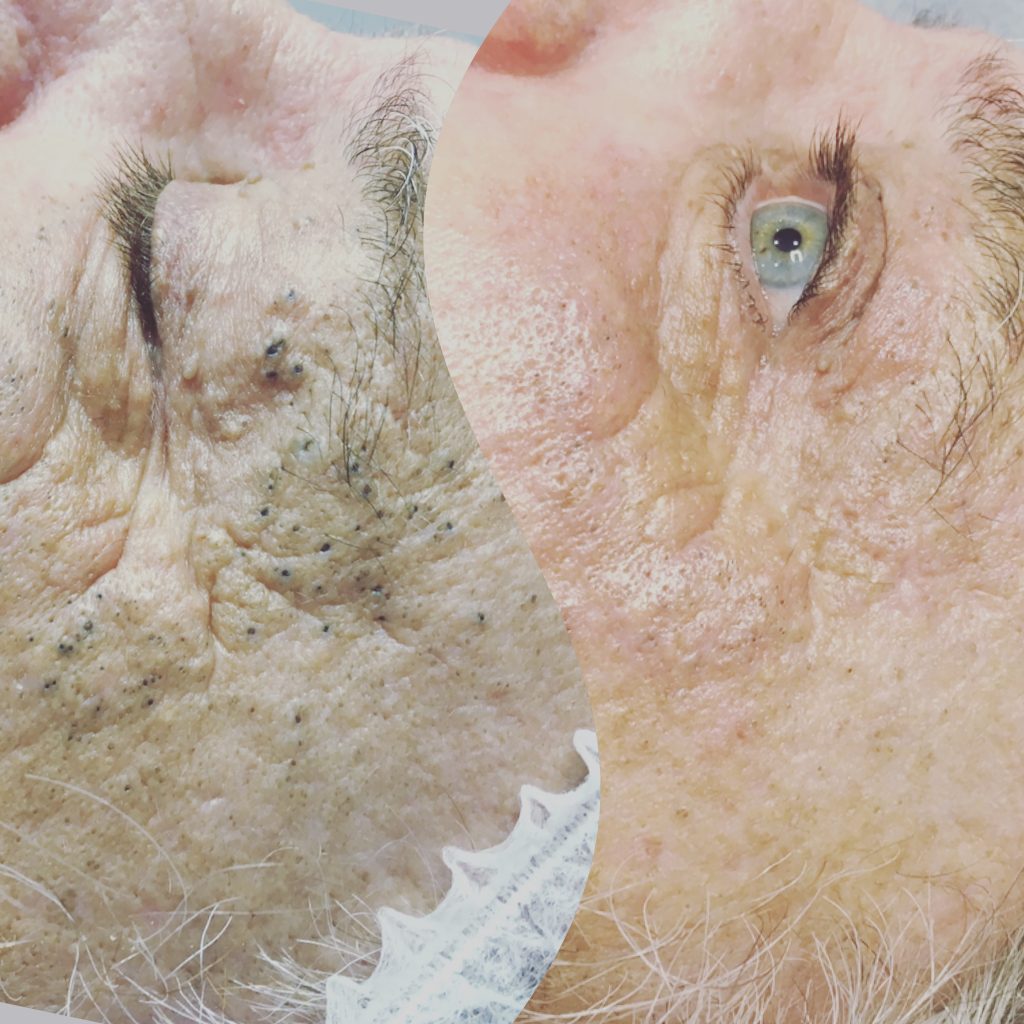 Facials Brisbane, Specialist Acne Extraction Facial & Blackhead Removal