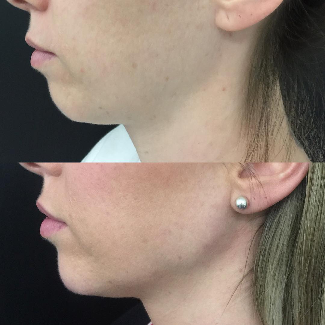 Chin Filler Brisbane Weak Chin, Chin Wrinkles, Crease or Line