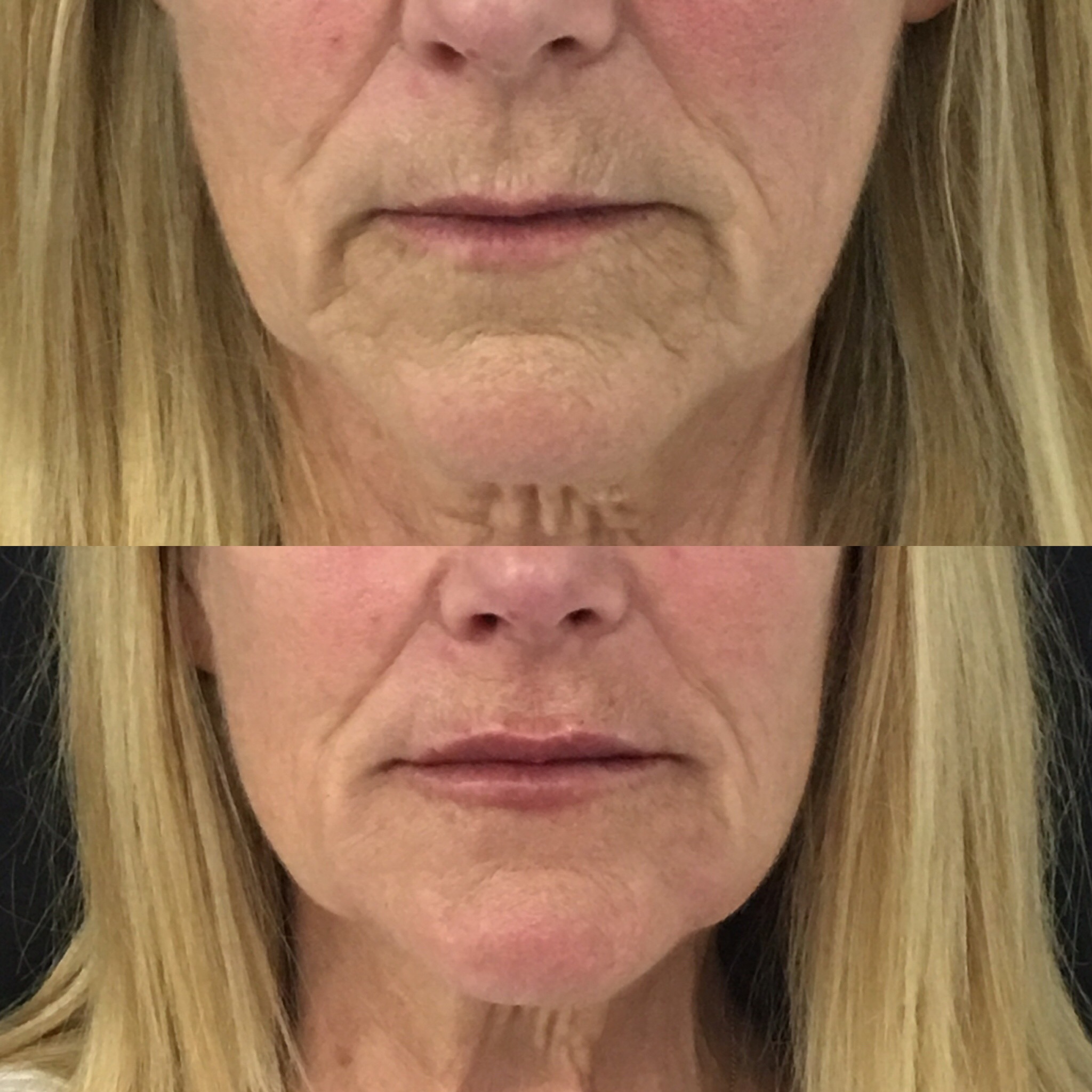 Chin Filler Brisbane Weak Chin, Chin Wrinkles, Crease or Line