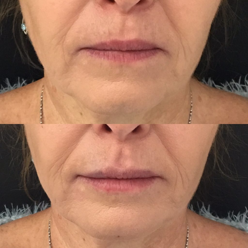 Nonsurgical Jowl Lift Jowl Treatment to Tighten Jowls, Filler for Jowls