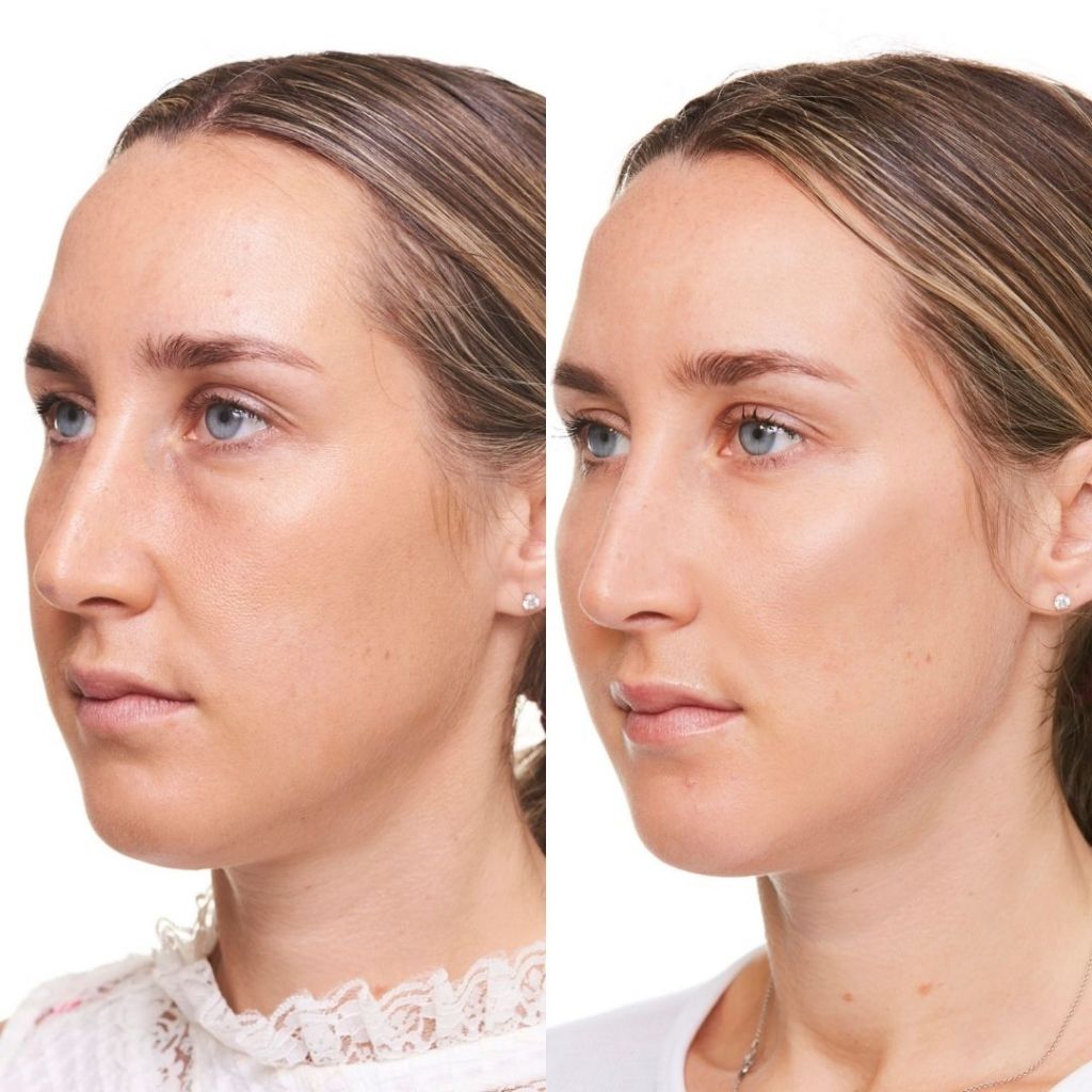 Dark Circles Under The Eyes Causes of Dark Circles and their Treatment