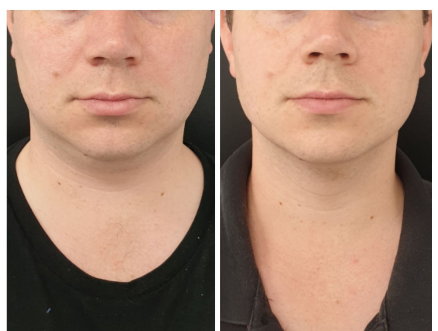 Double Chin Treatment with Fat Dissolving Injections Only 396