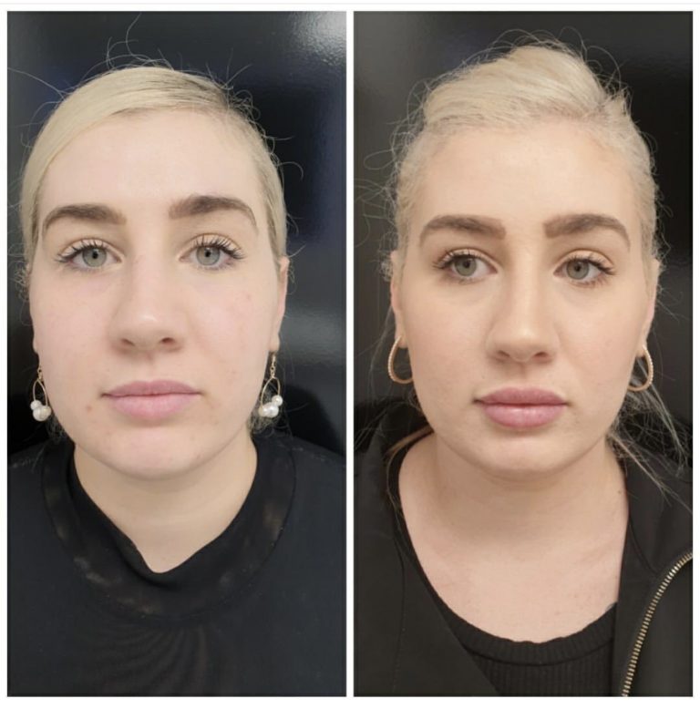 Double Chin Treatment with Fat Dissolving Injections Only 396