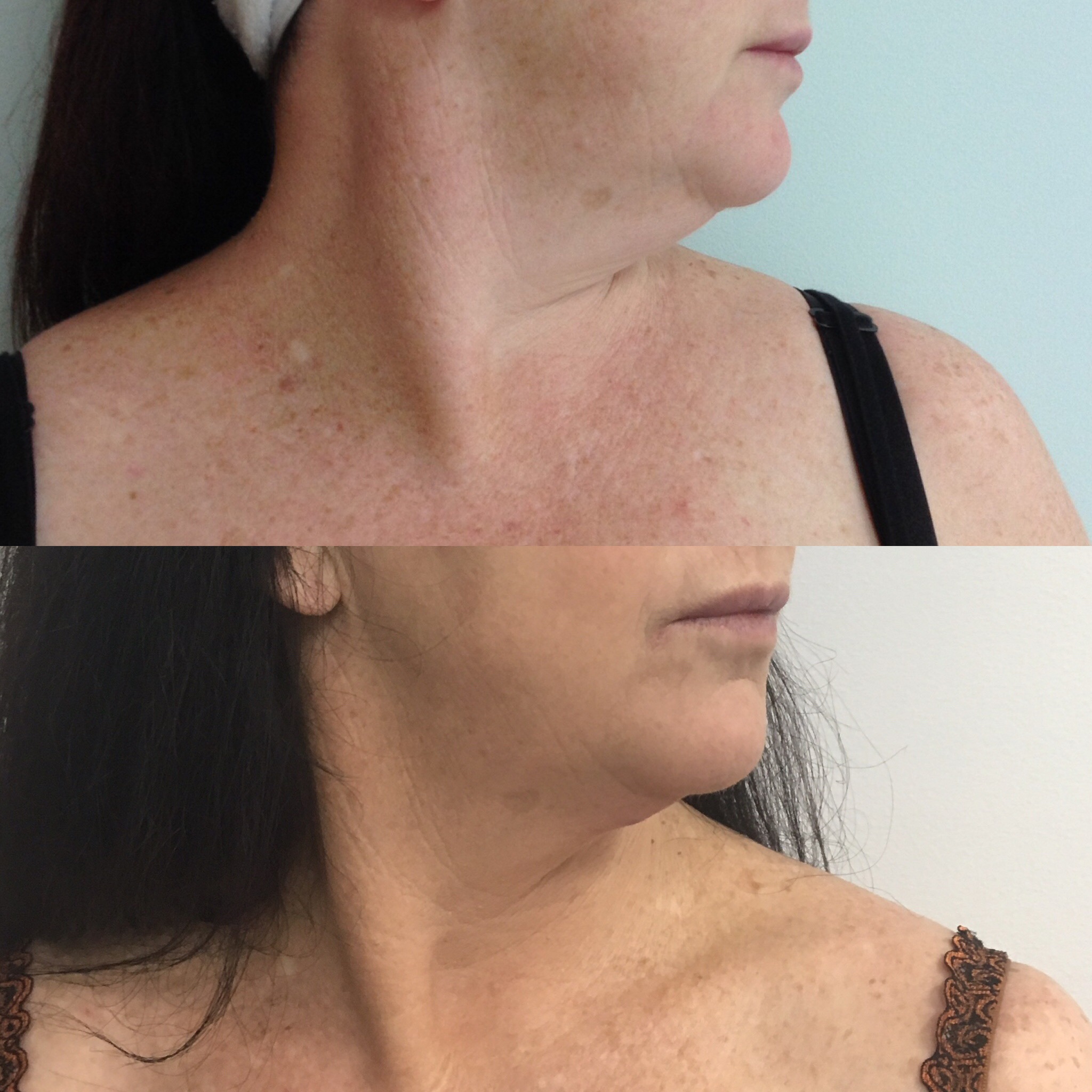 Double Chin Removal Double Chin Injection, Liposuction & Fat Freezing