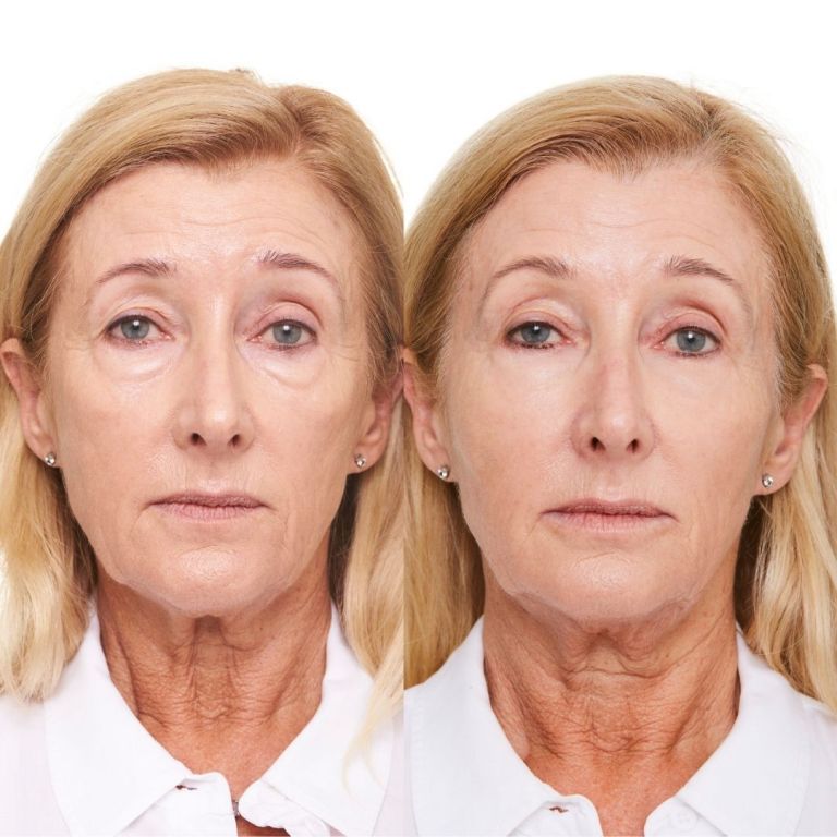 Tear Trough Filler for Dark Circles & Eye Bags Under Eye Wrinkles Filler