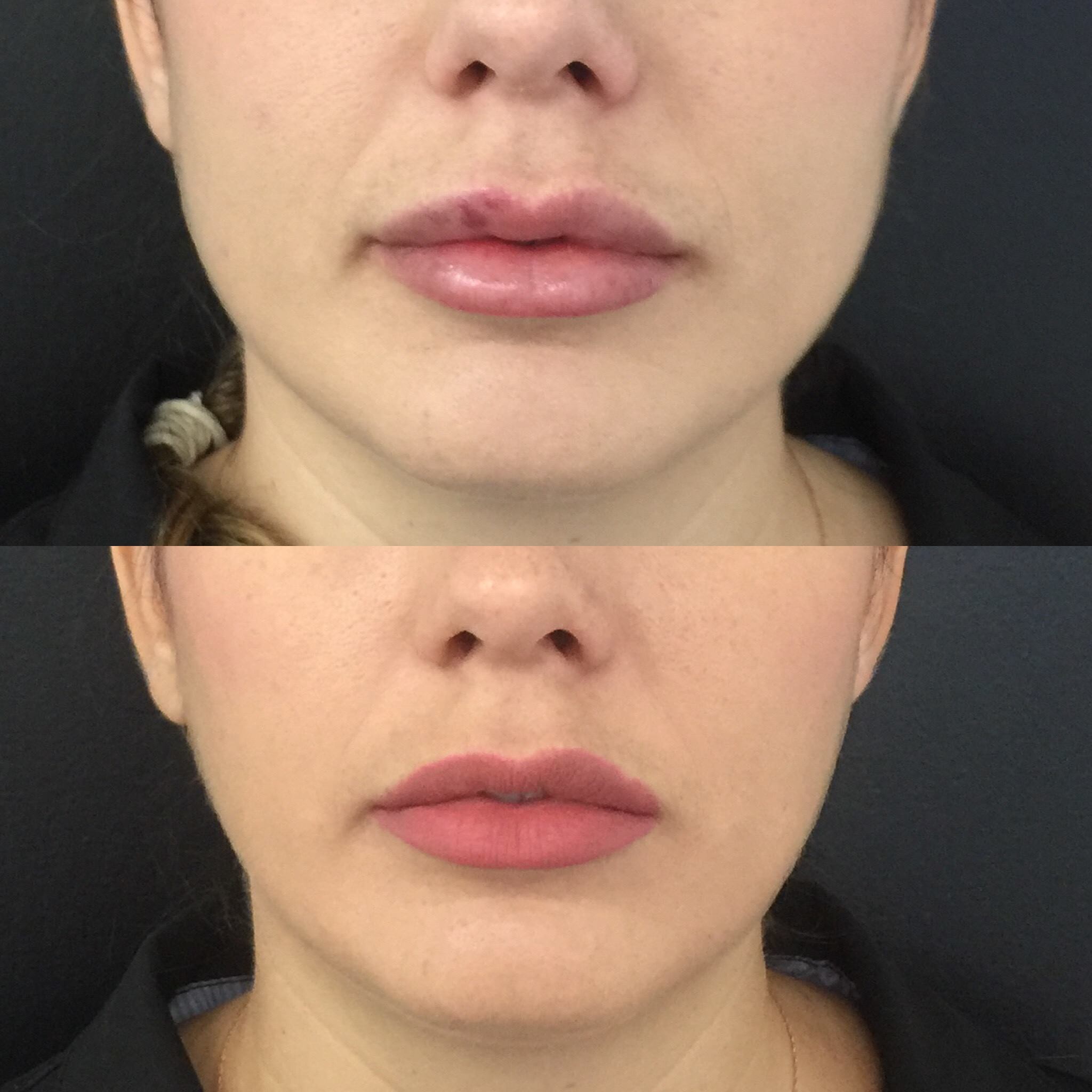 Masseter Injections, Double Chin Injections and Fillers to Slim your Face