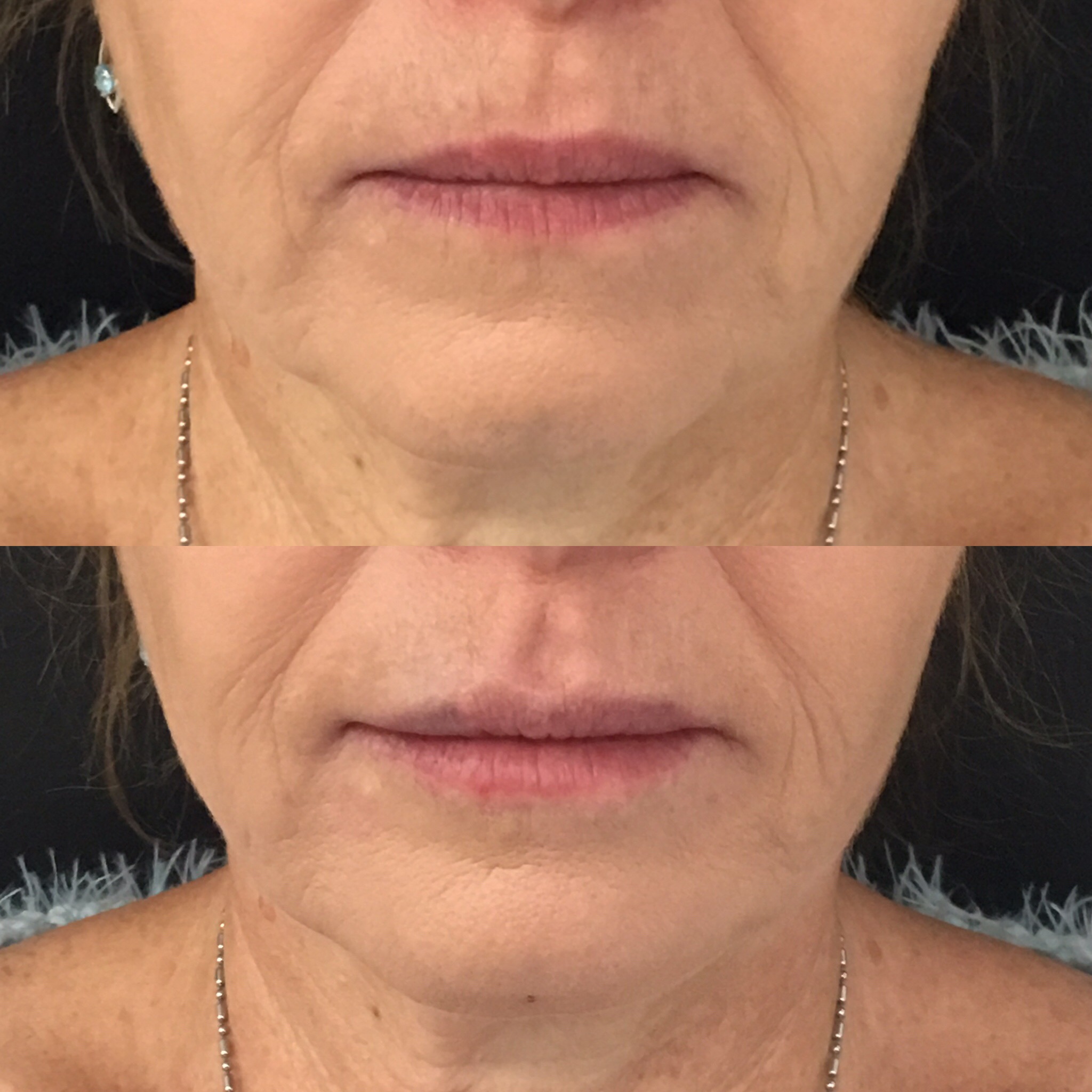 Laser Lip Lines Treatment Laser & Fillers for Lip Wrinkle & Smokers Lines