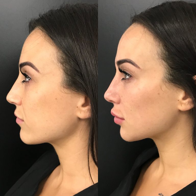 Dermal Filler Brisbane Cosmetic and Face Filler Packages