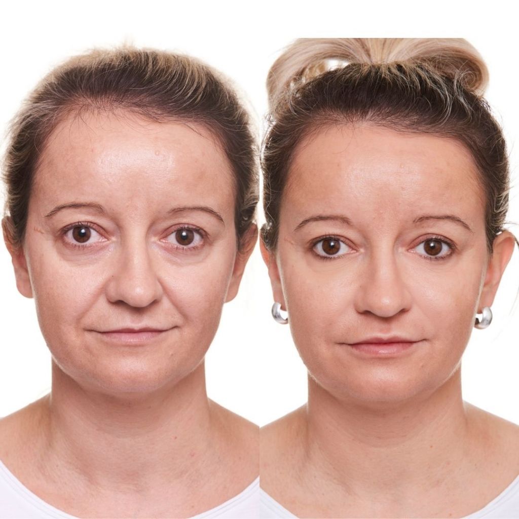 Tear Trough Filler for Dark Circles & Eye Bags Under Eye Wrinkles Filler