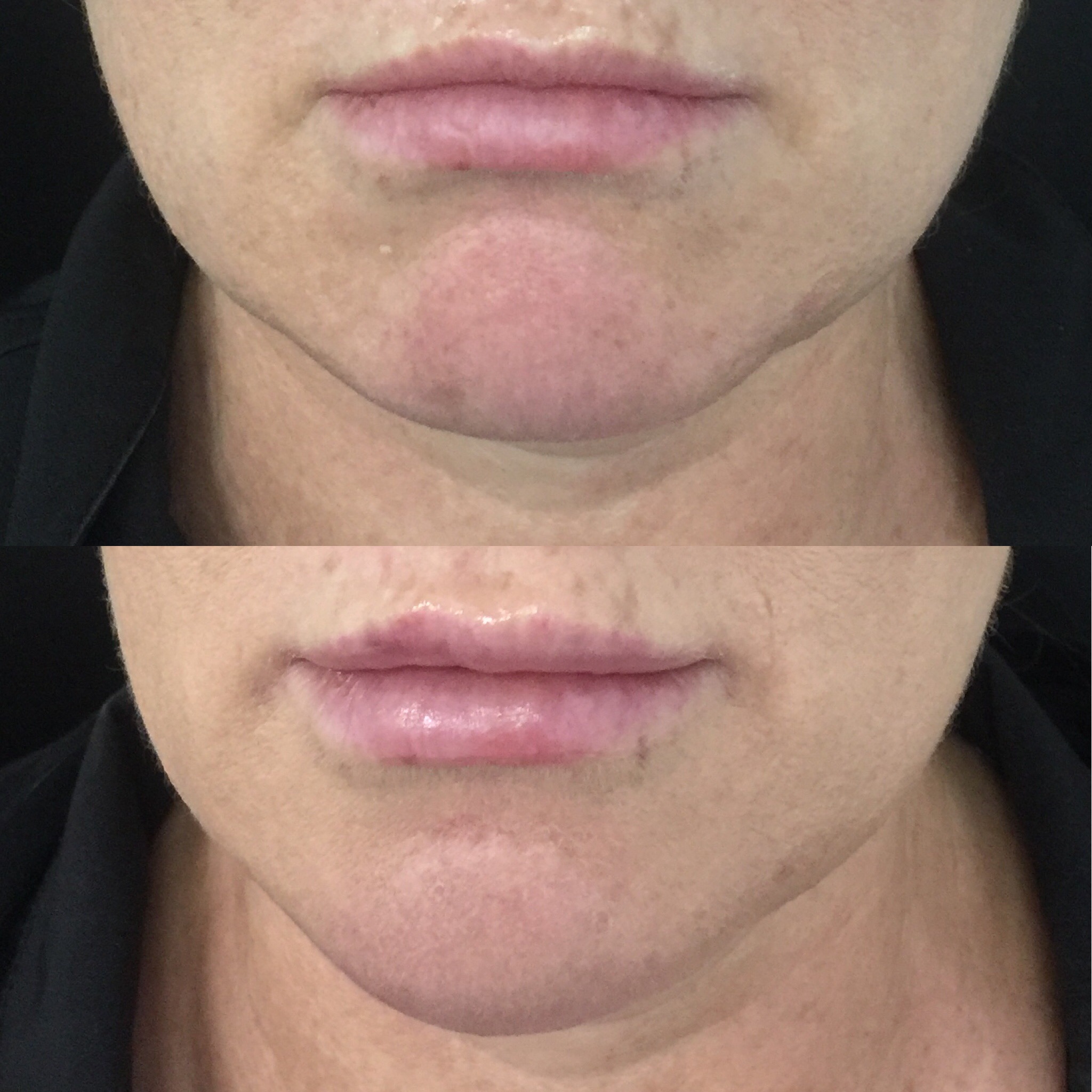 Masseter Injections for Jaw Slimming, Teeth Grinding or Jaw Clenching