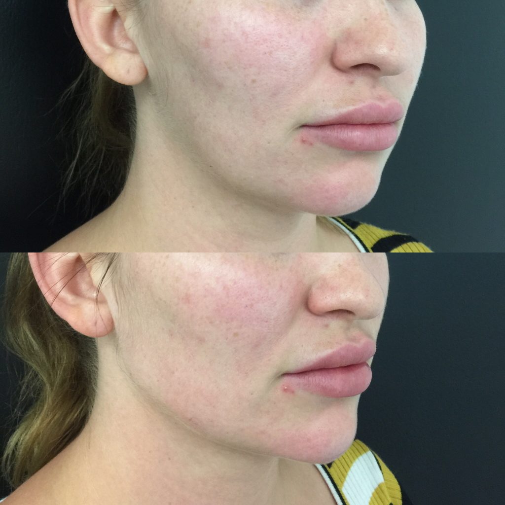 Jawline Filler Brisbane Jawline and Chin Contouring, Jowl Filler and Lift