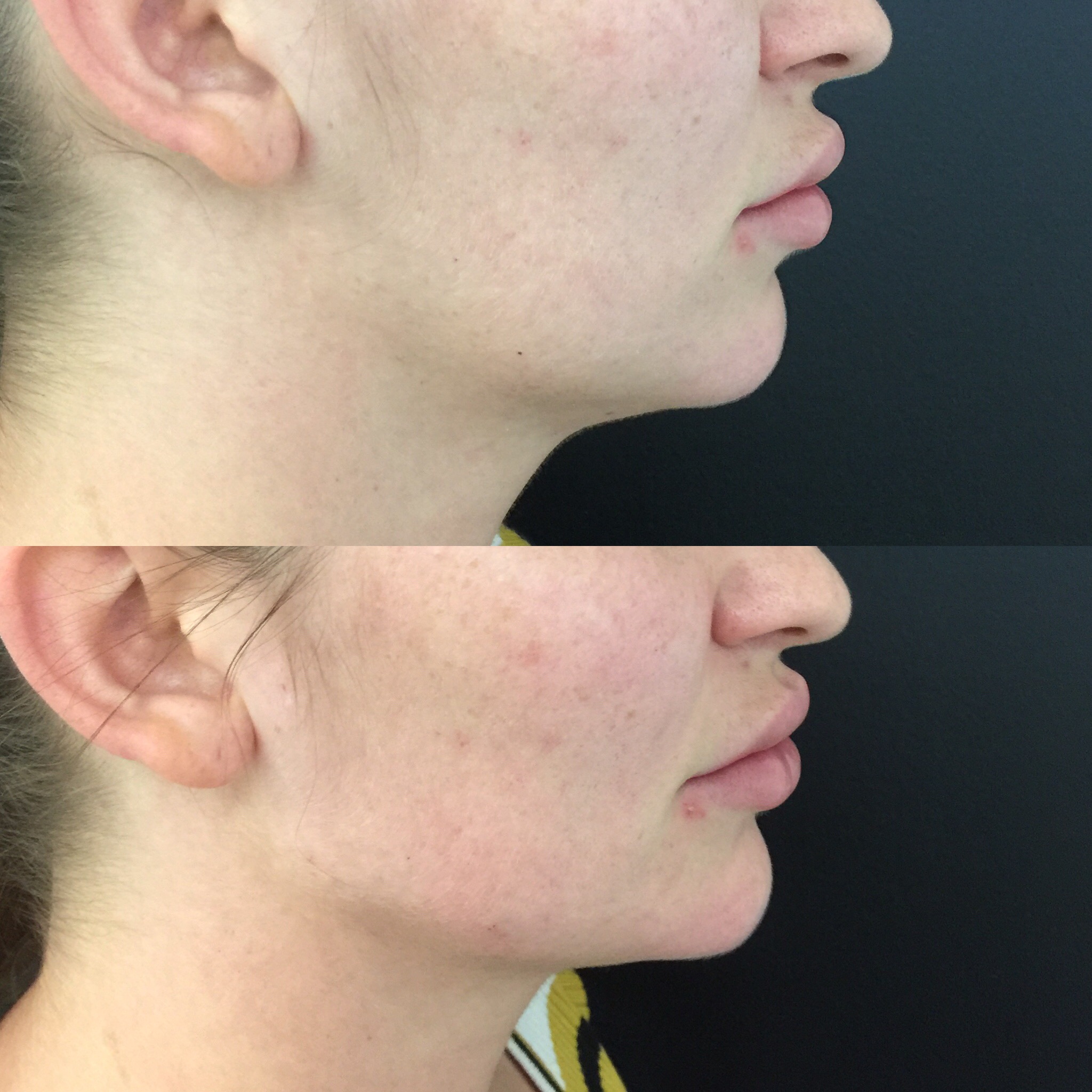 Jawline Fillers Brisbane Dermal Fillers for nonsurgical Jaw Enhancement
