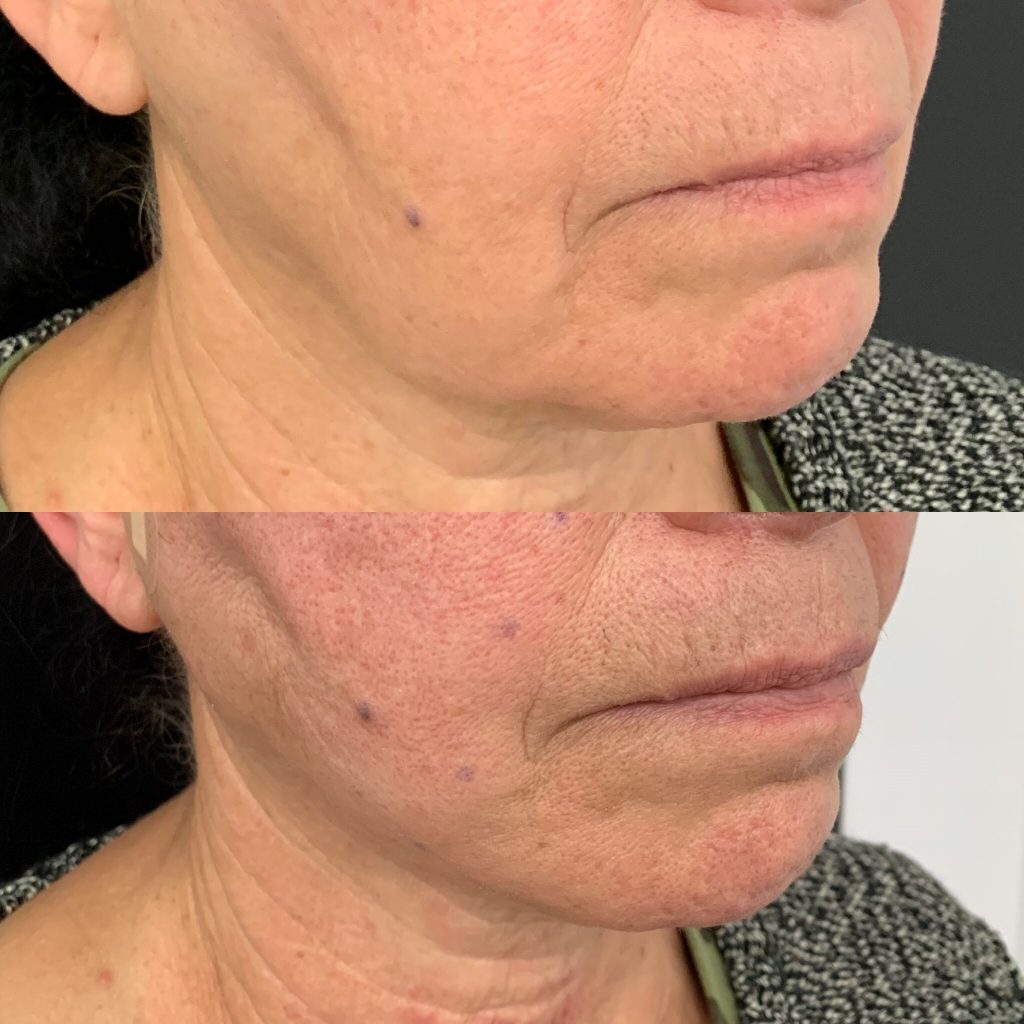 Nonsurgical Jowl Lift Thread Lift, HIFU, Injectables & Fillers for Jowl