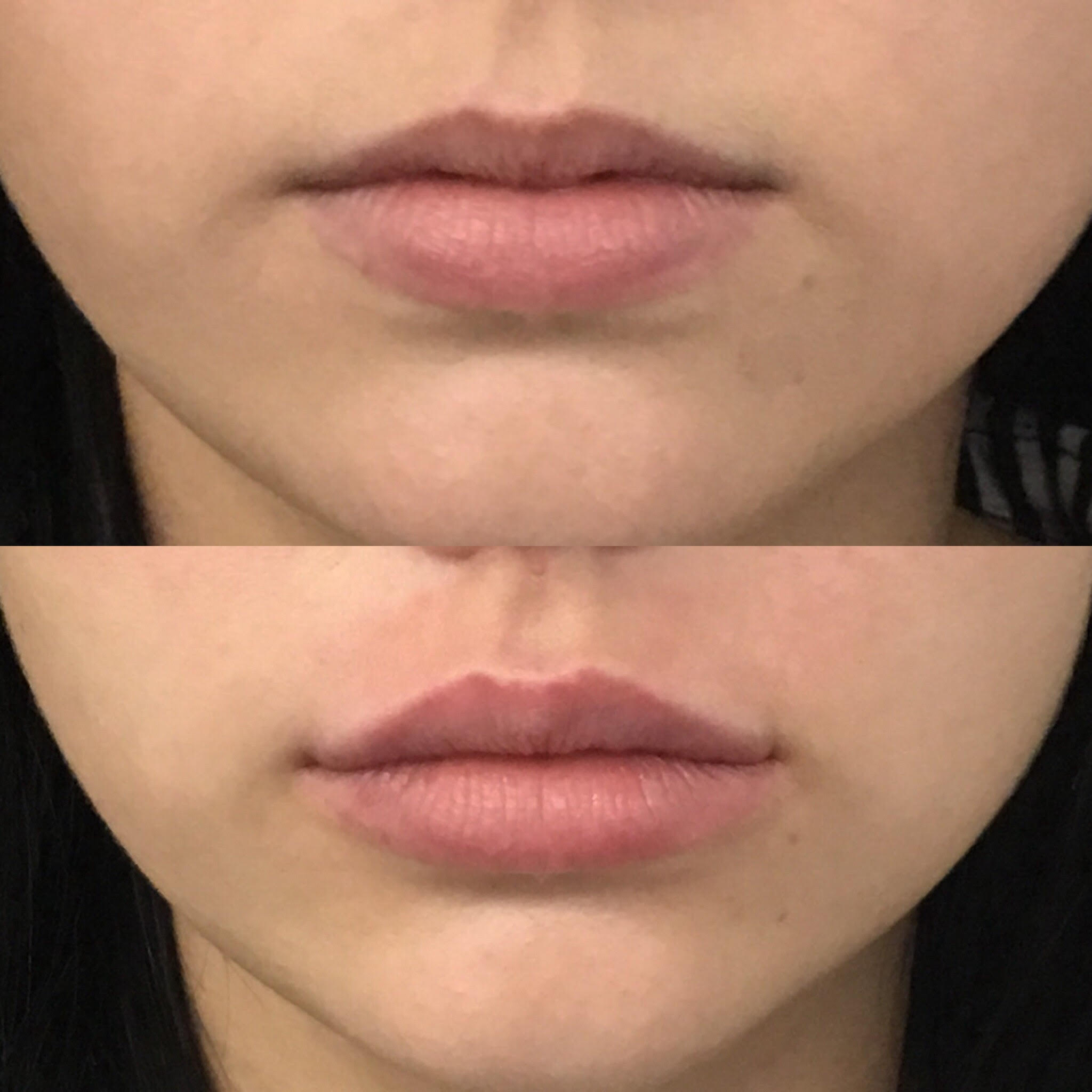 Lip Filler Brisbane Lip Injections 1ml Lip Filler Natural Lip Fillers
