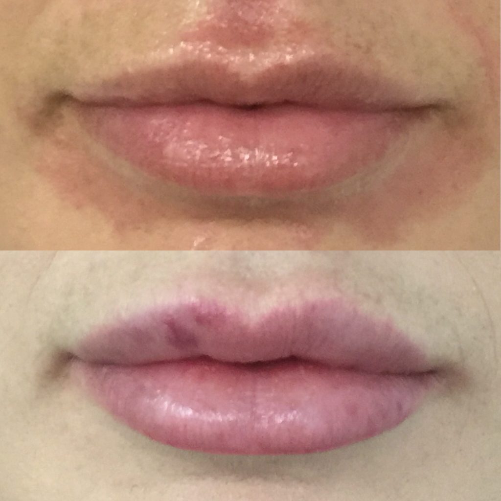 Lip Filler Brisbane Lip Injections 1ml Lip Filler Natural Lip Fillers