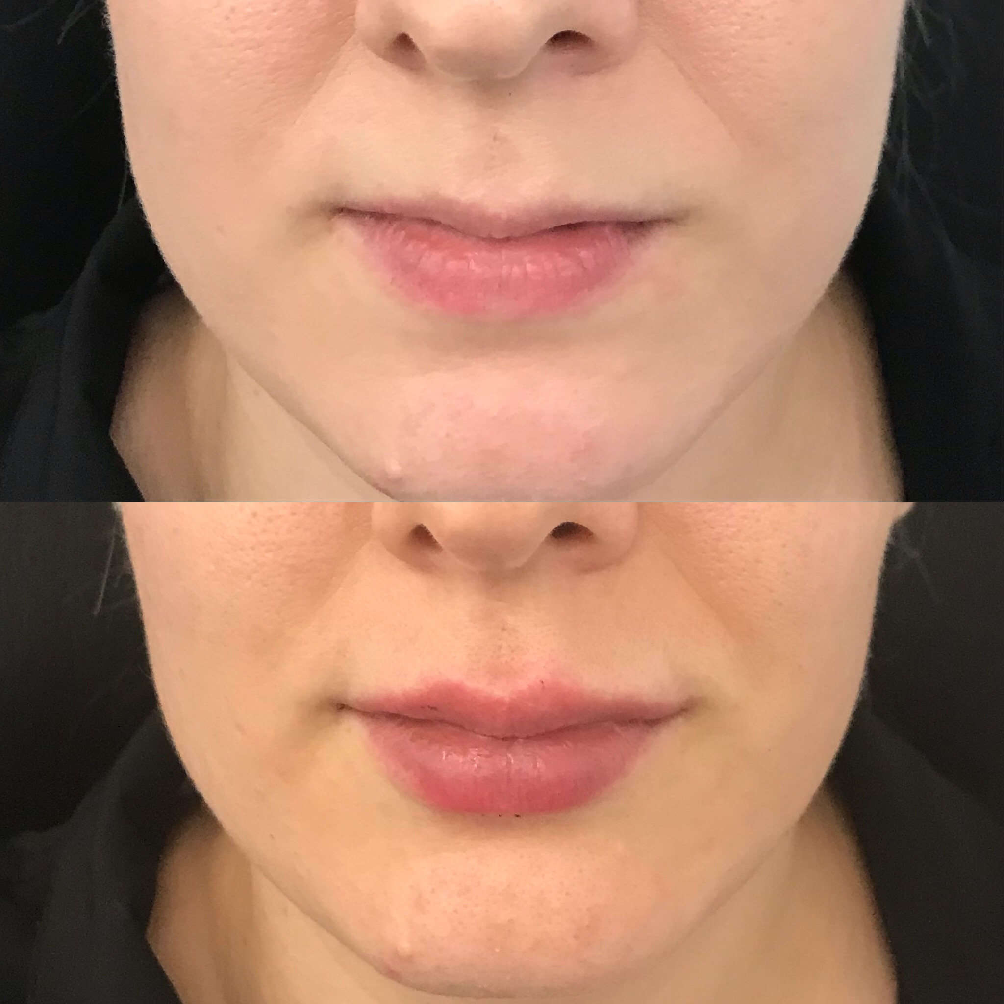 Lip Filler Brisbane Lip Injections 1ml Lip Filler Natural Lip Fillers