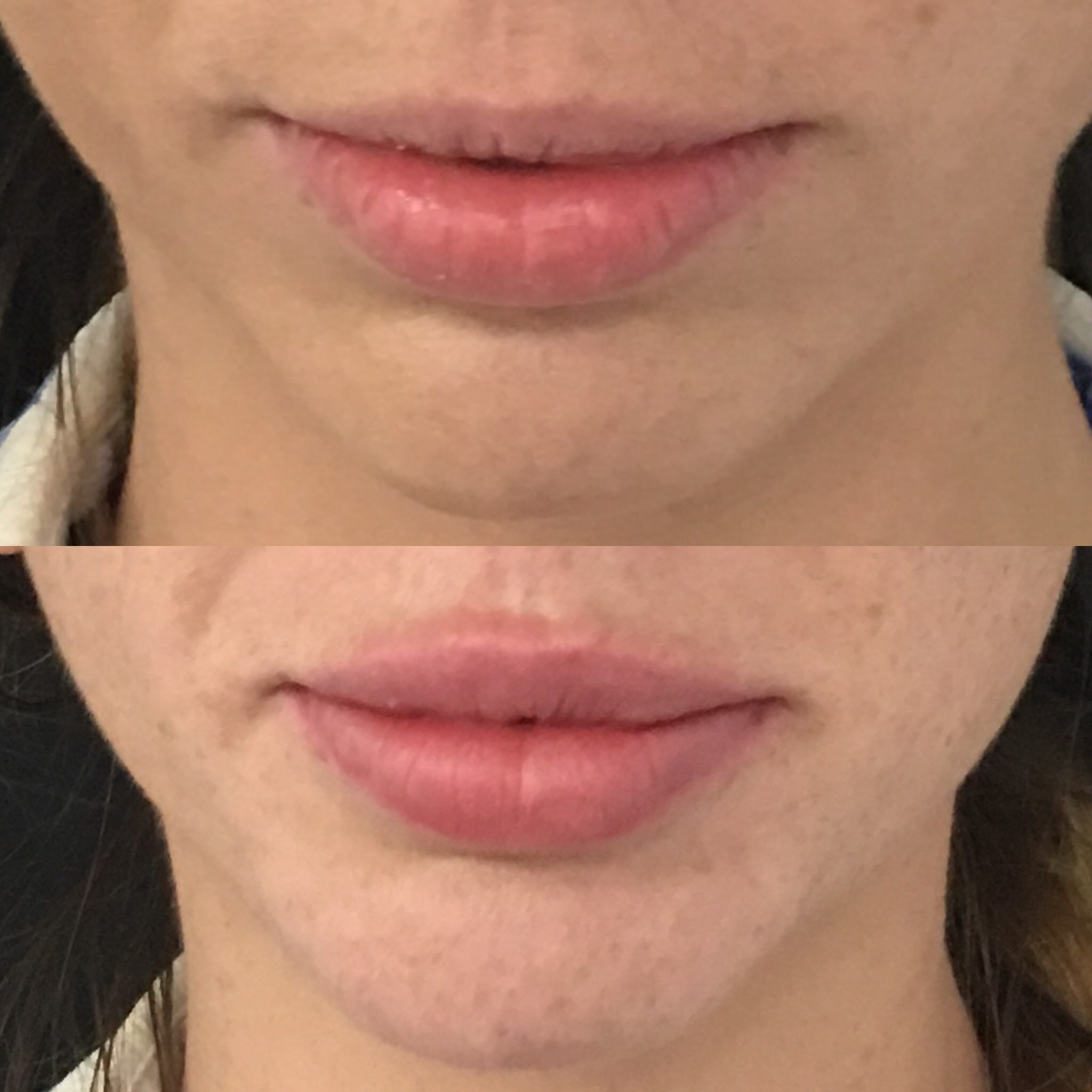 Lip Filler Brisbane Lip Injections 1ml Lip Filler Natural Lip Fillers